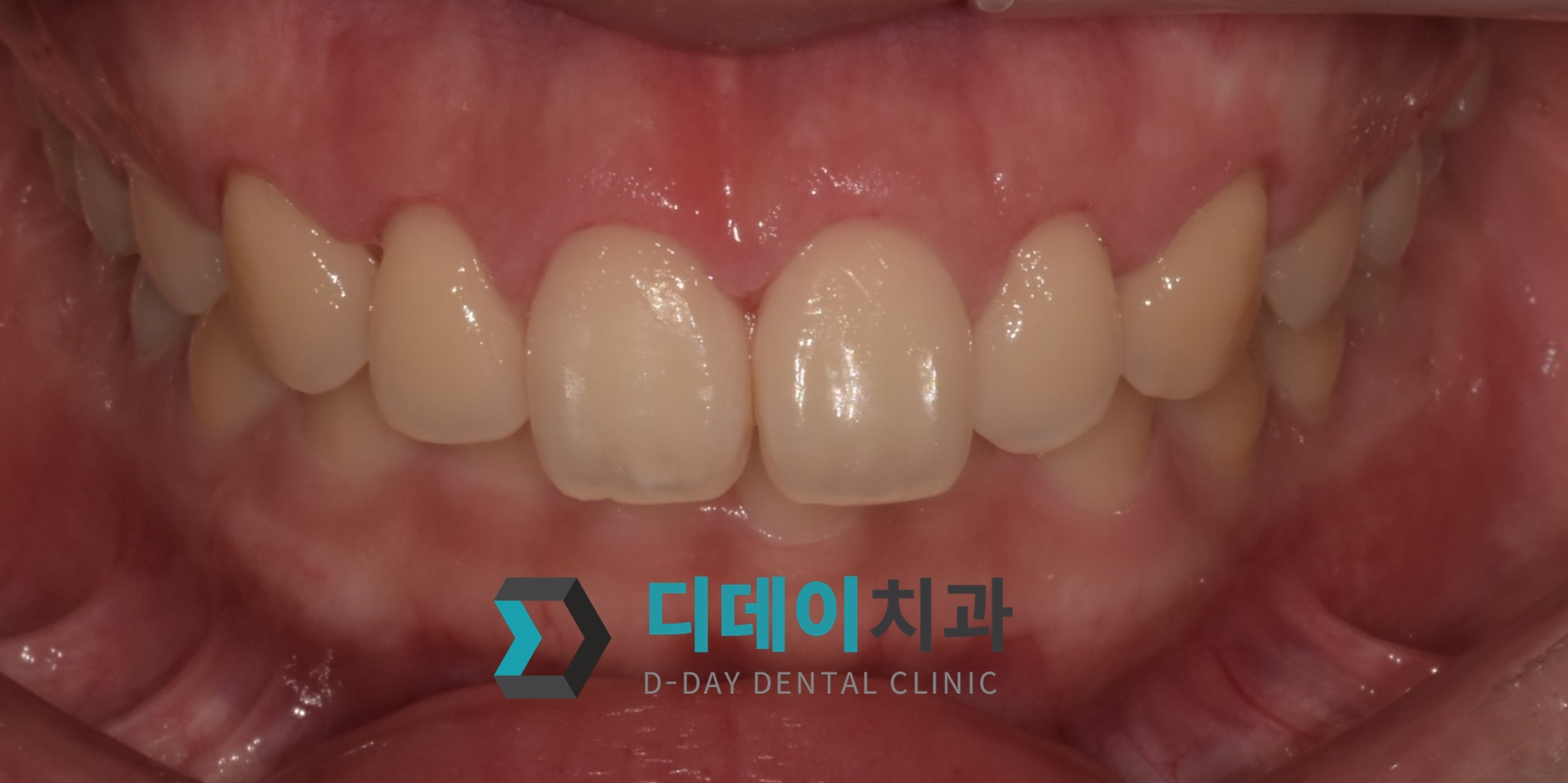 잇몸 성형 치료 후