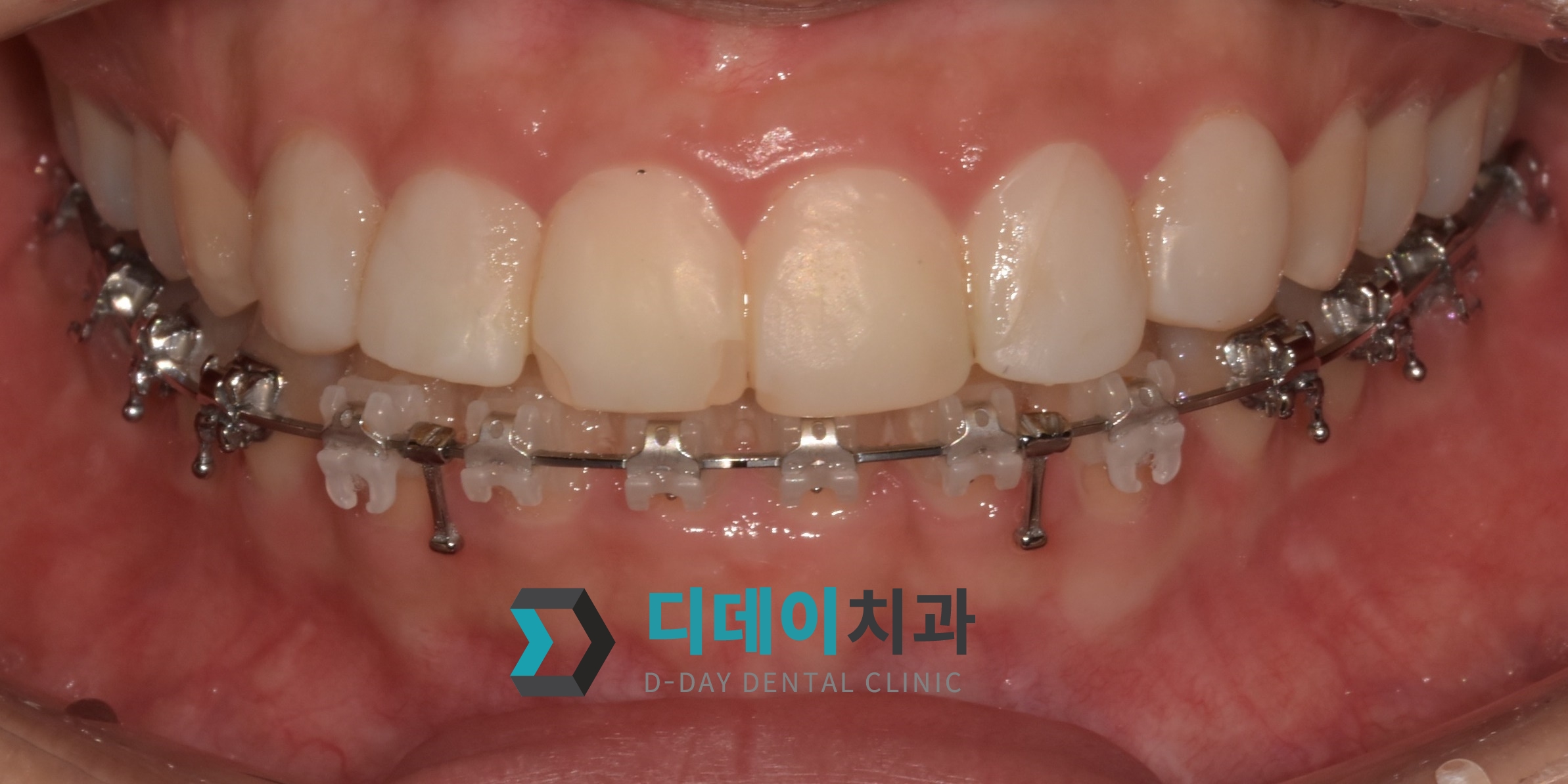 라미네이트 치료 전