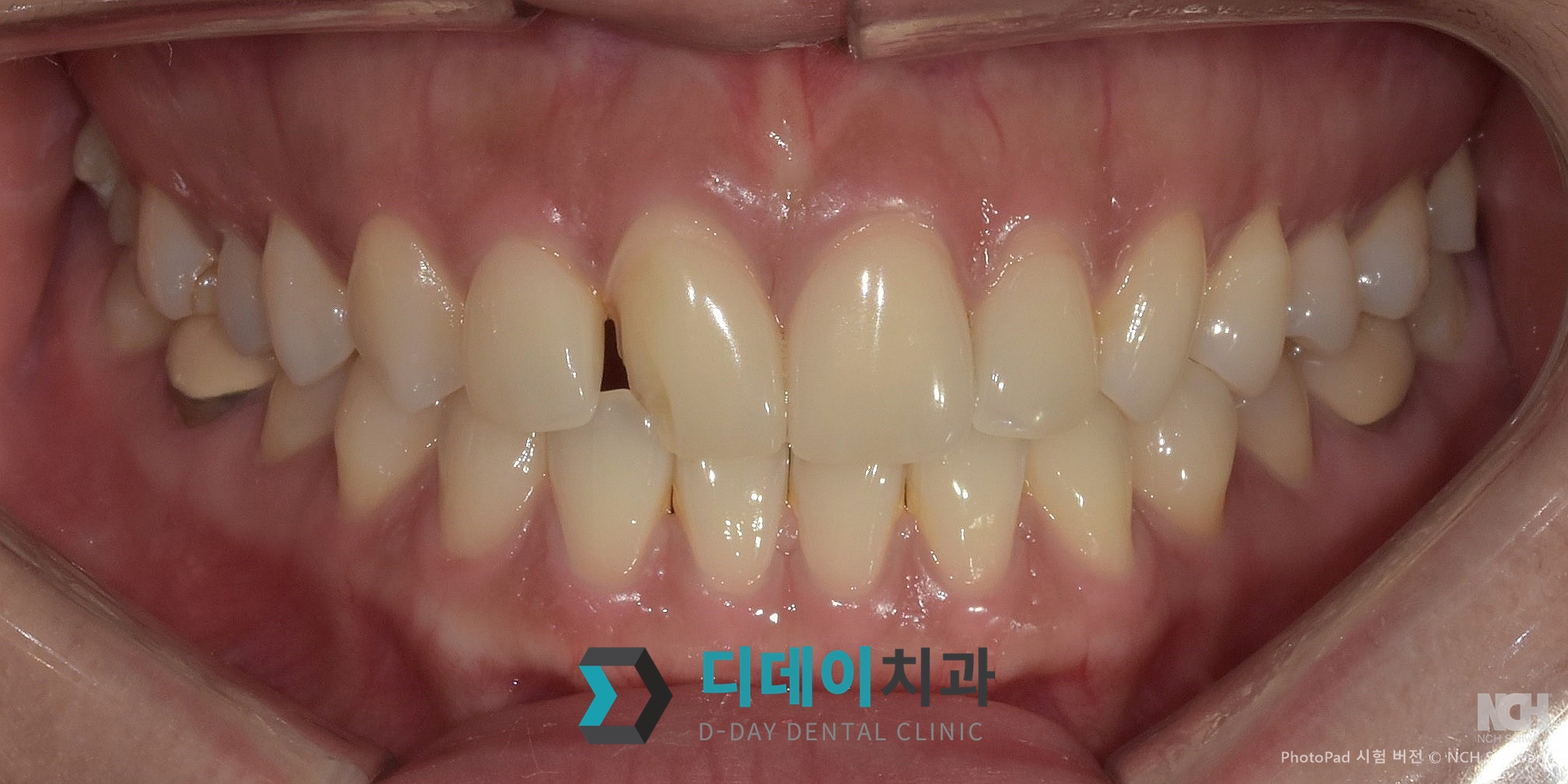 라미네이트 재시술 치료 전