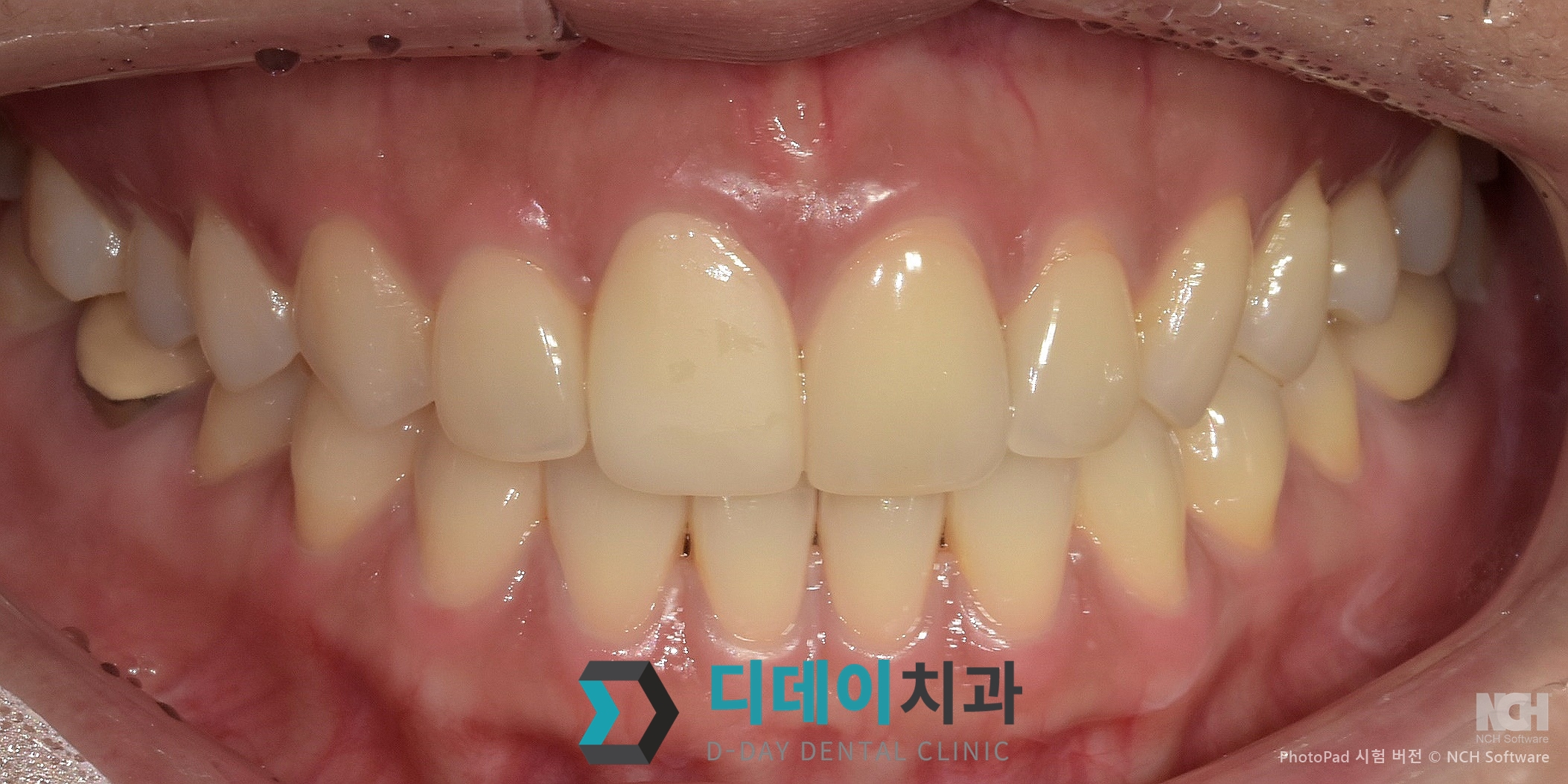 라미네이트 재시술 치료 후