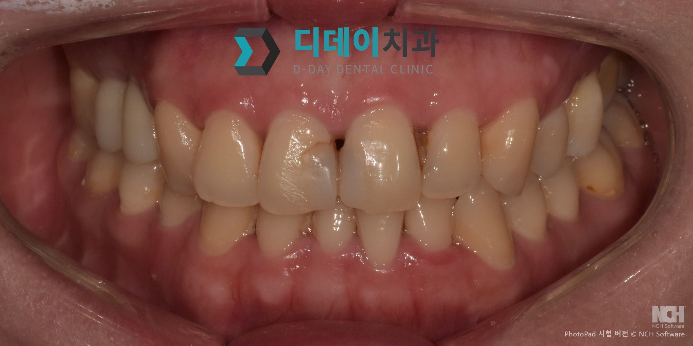 라미네이트 치료 전