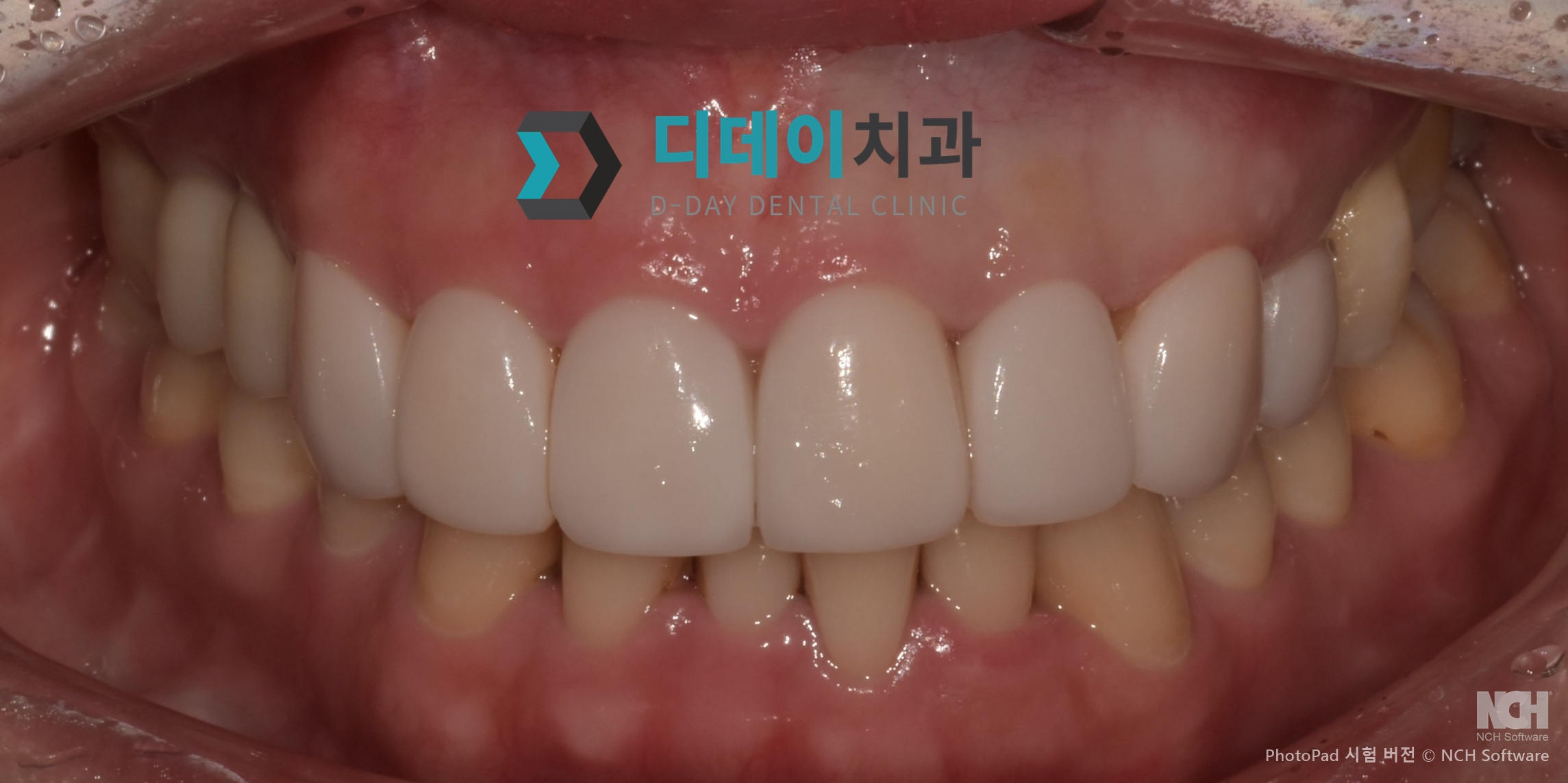 라미네이트 치료 후