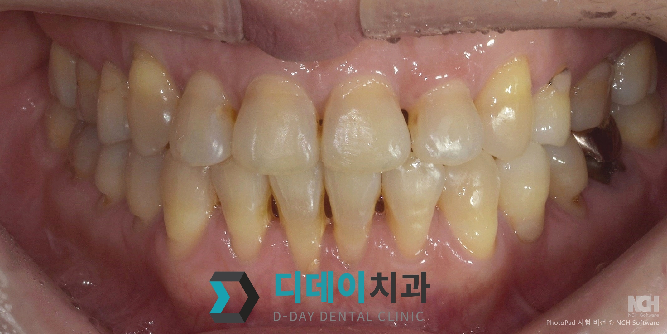 라미네이트 치료 전