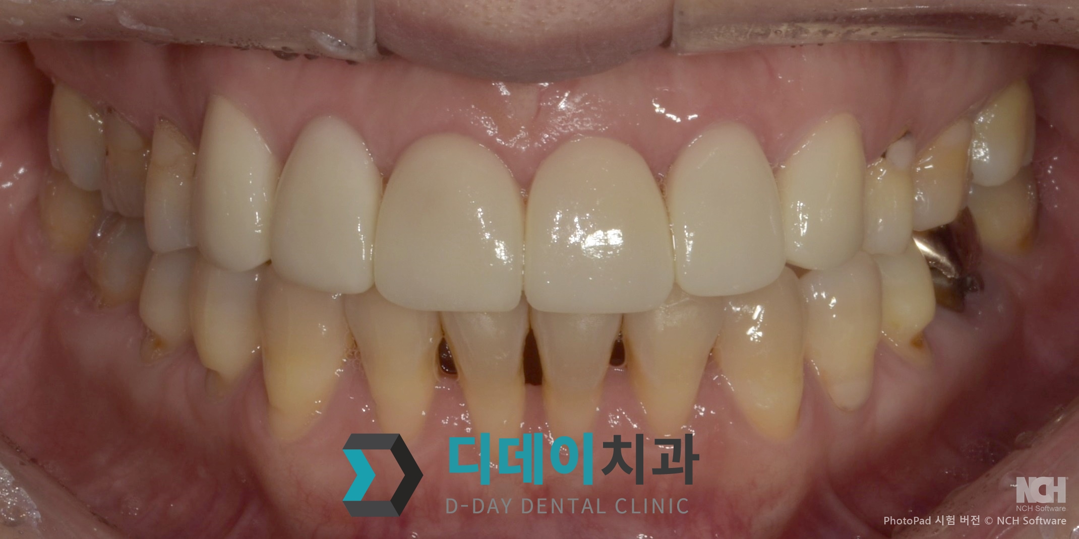 라미네이트 치료 후