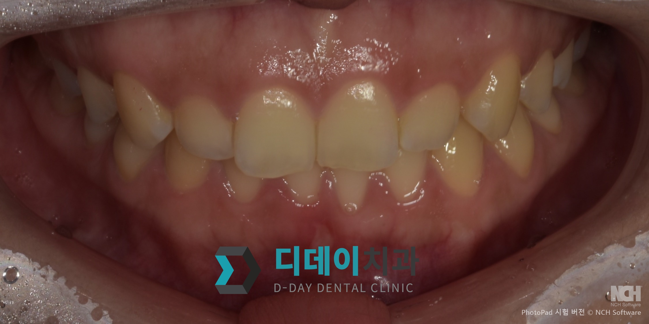 잇몸 성형 치료 전