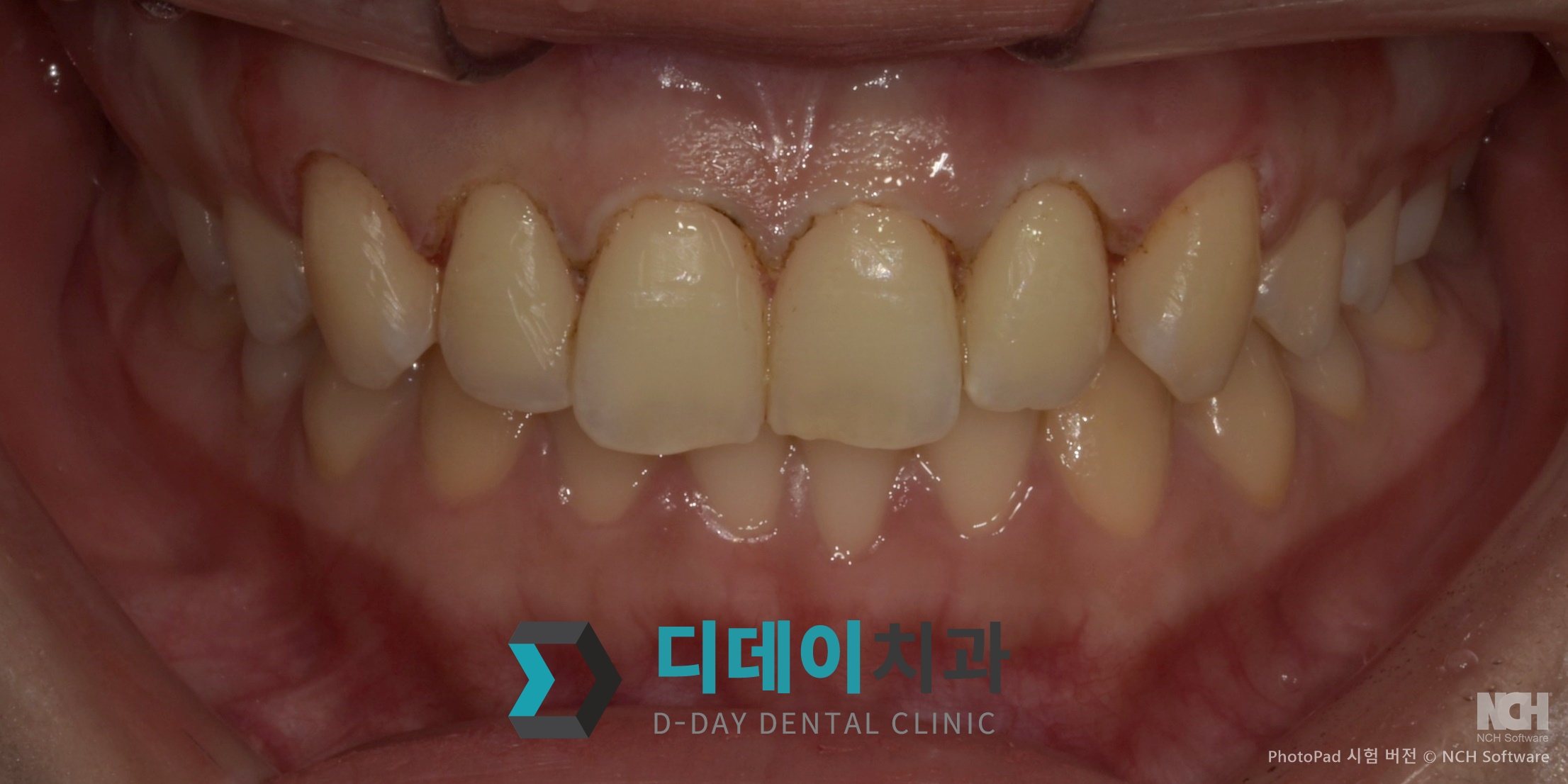 잇몸 성형 치료 후