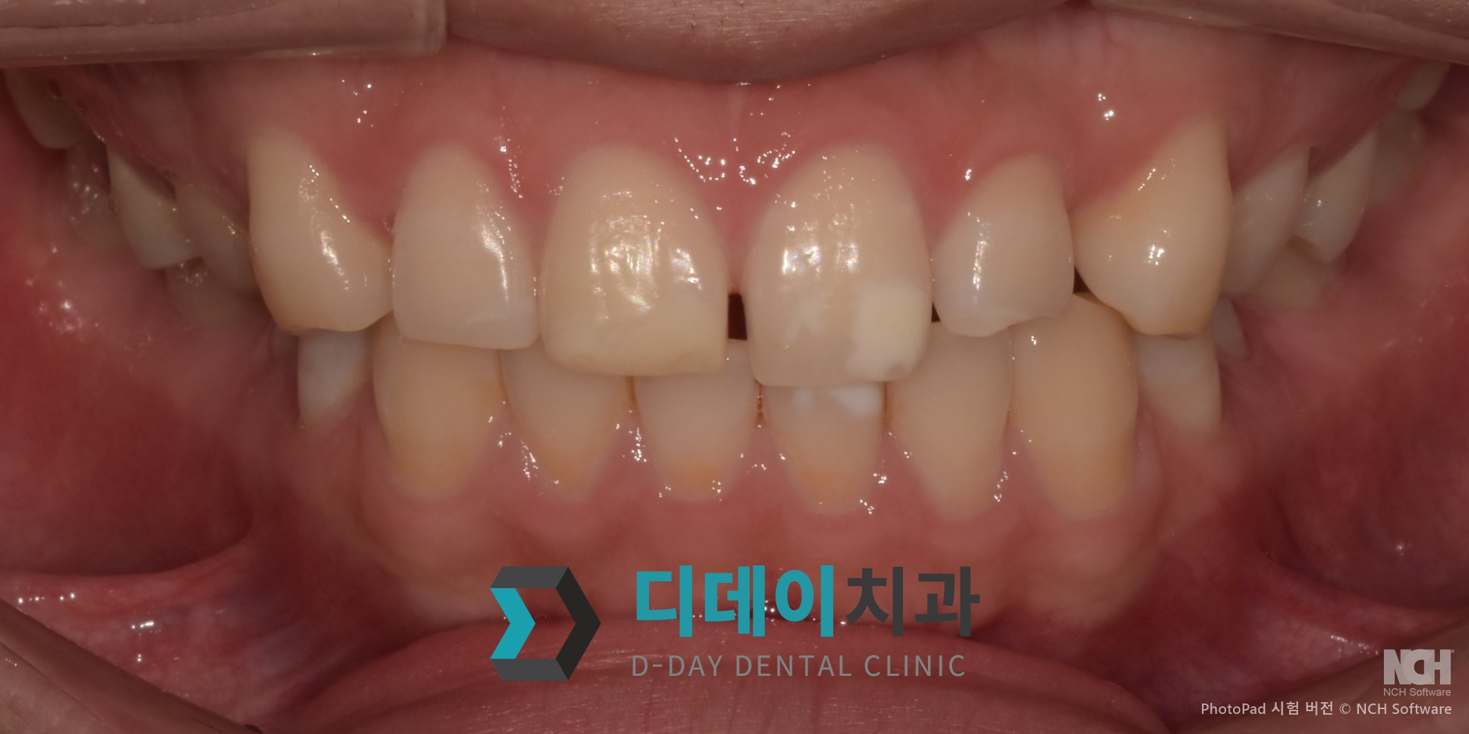 라미네이트 치료 전