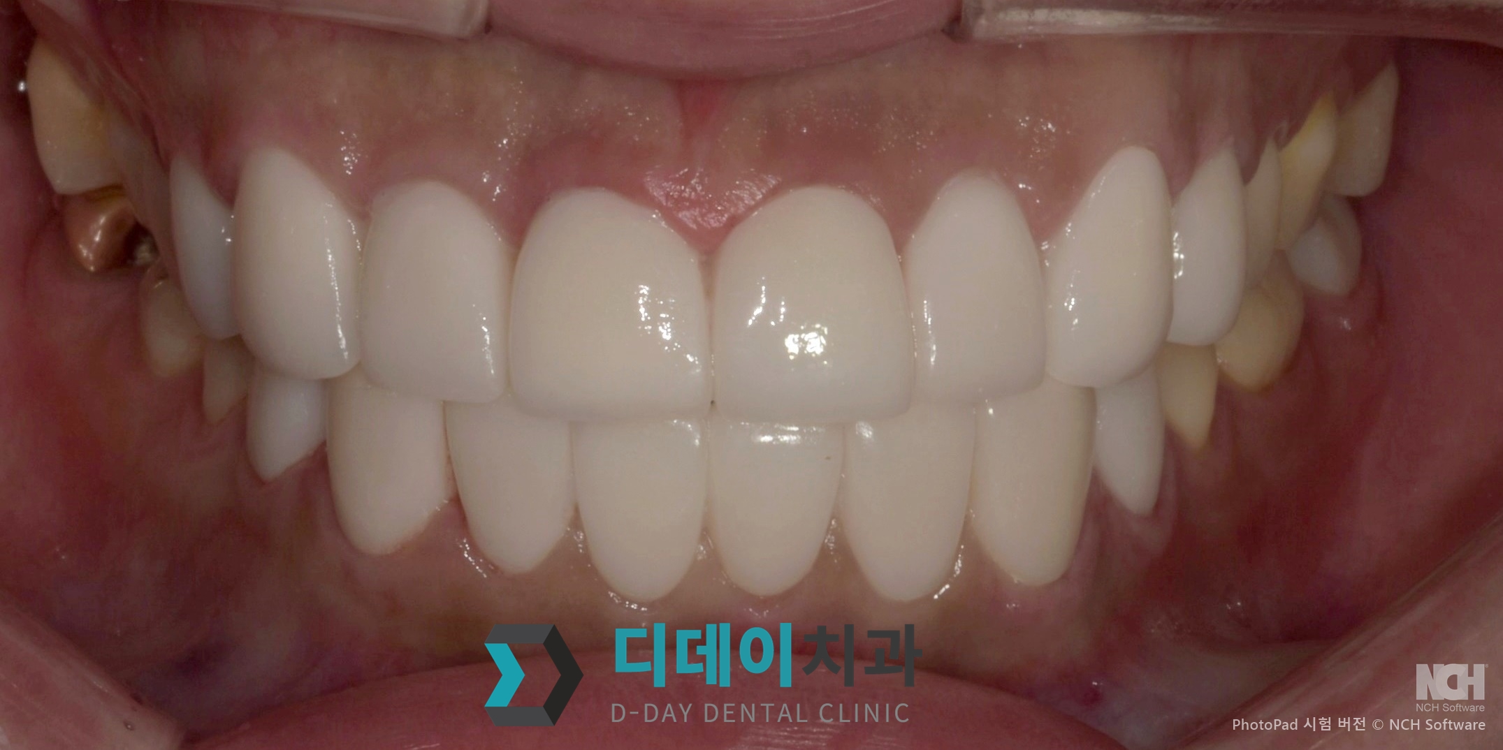 라미네이트 치료 후
