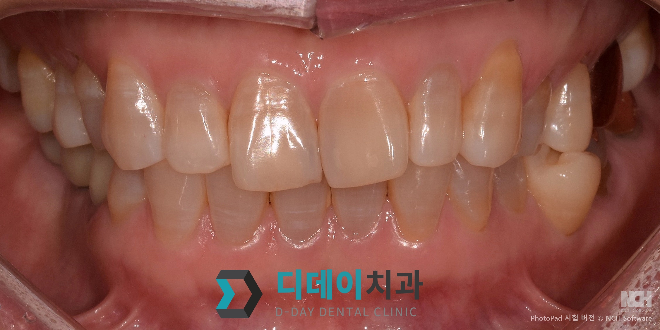 라미네이트 치료 전