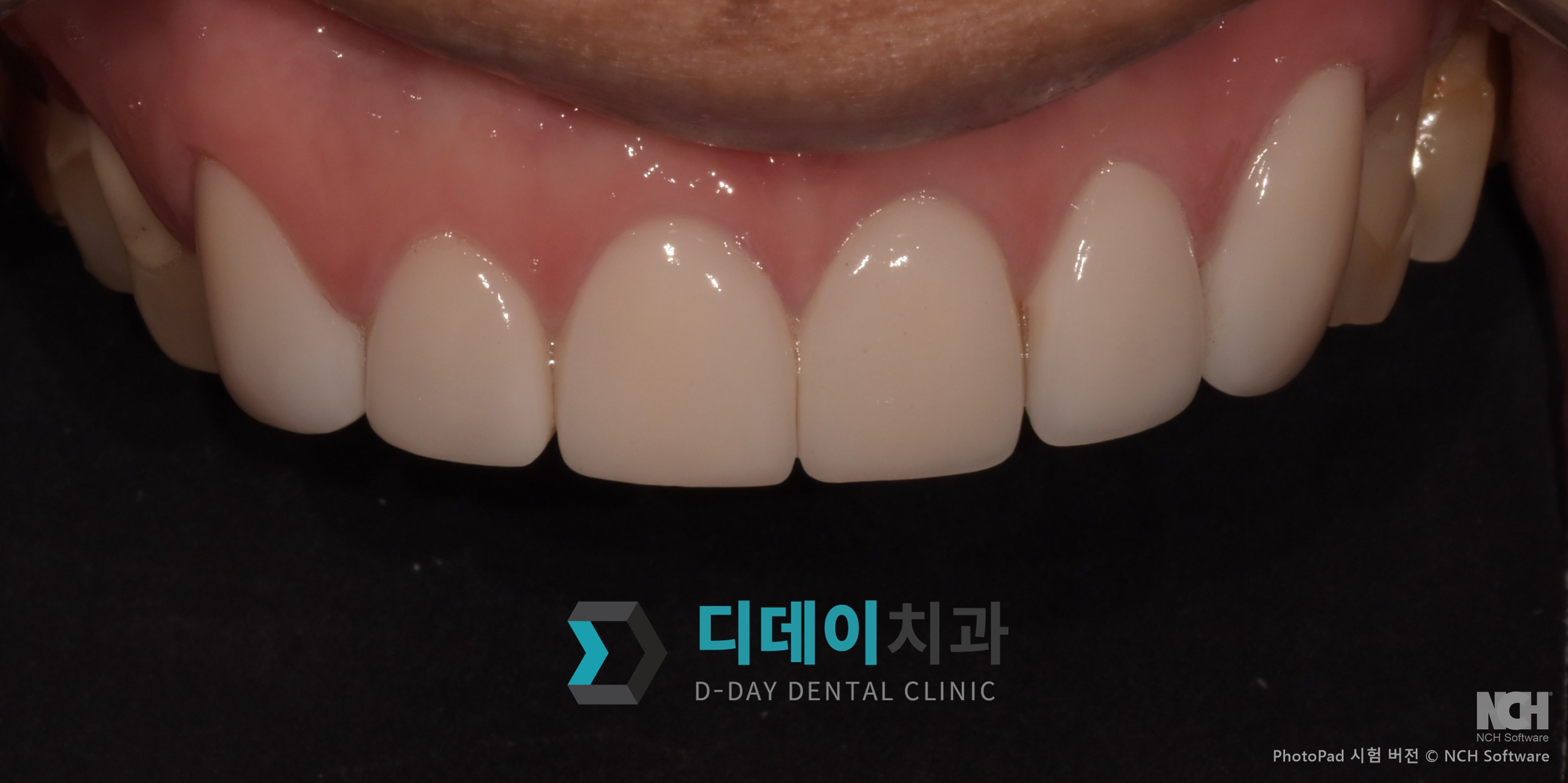 라미네이트 치료 후
