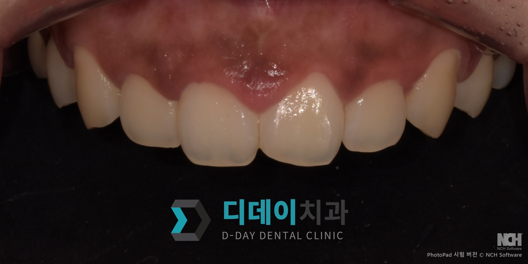 잇몸 성형 + 레진 치료 전