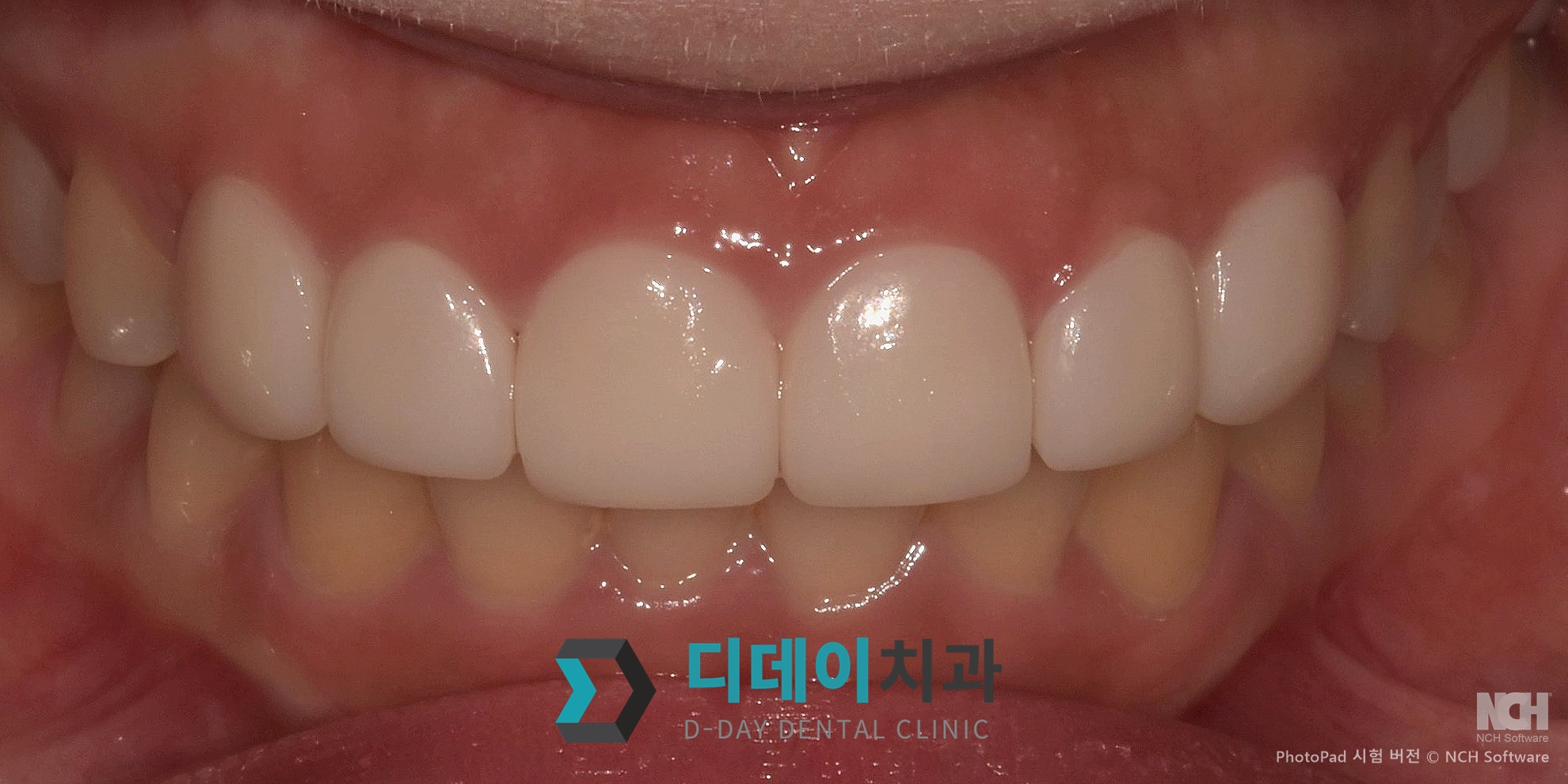 라미네이 치료 후
