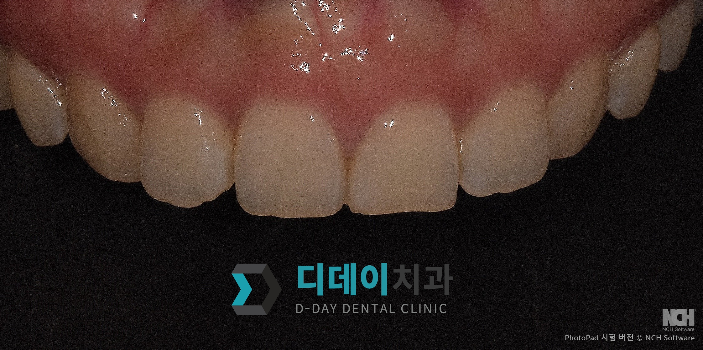 잇몸 성형 치료 전