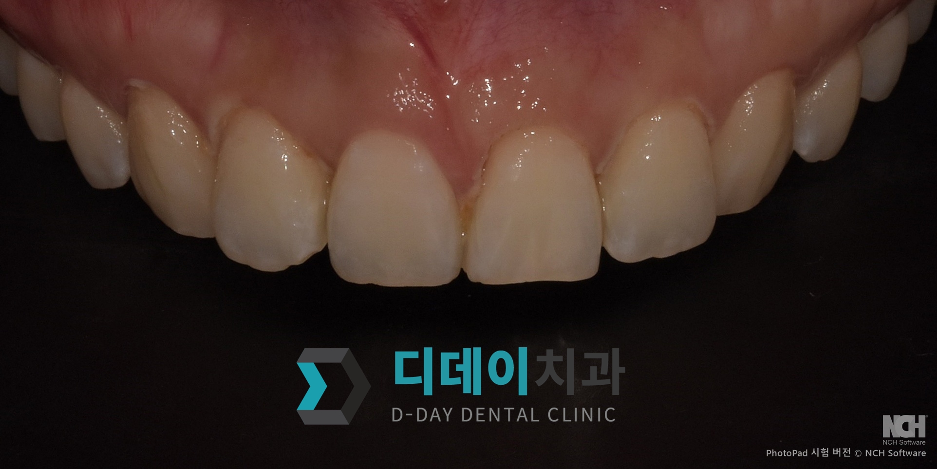 잇몸 성형 치료 후