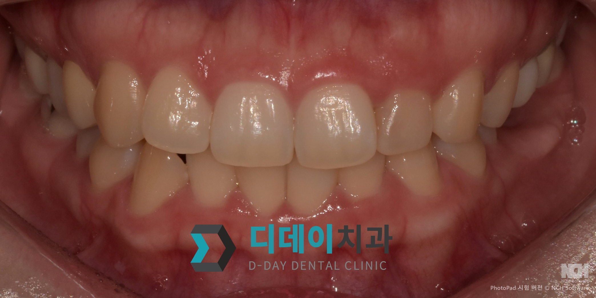 잇몸 성형 치료 전