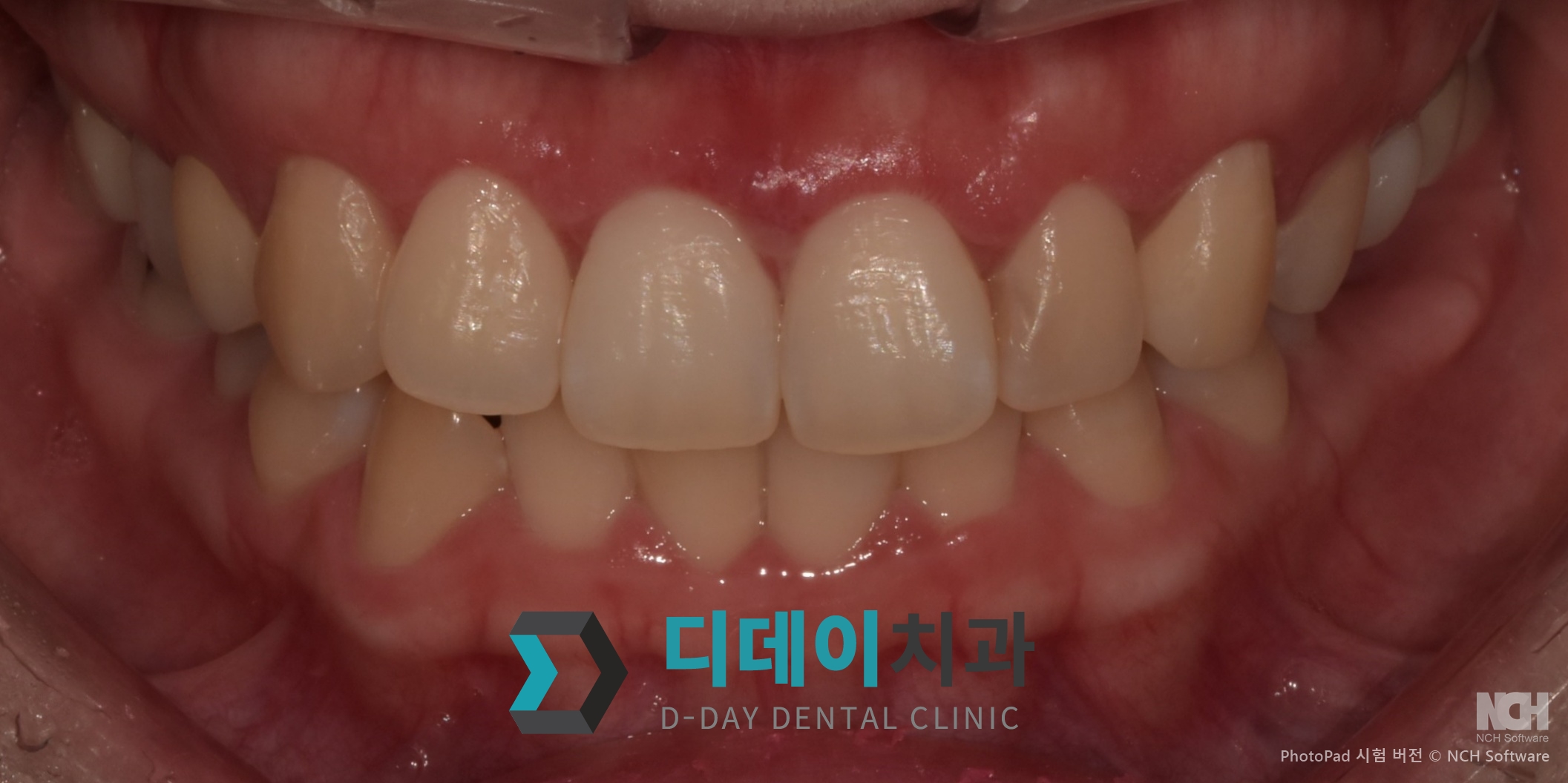 잇몸 성형 치료 후