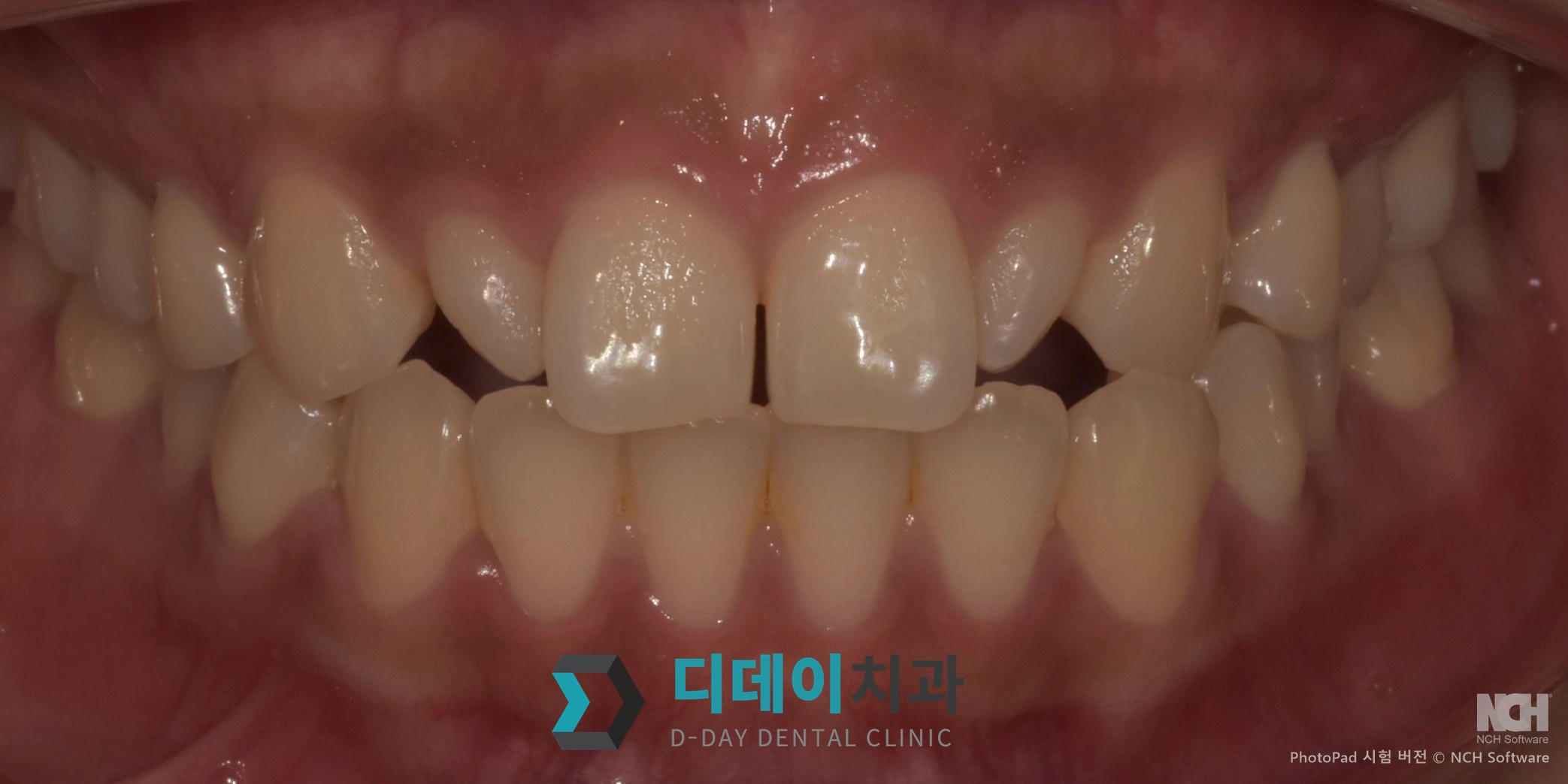 라미네이트 치료 전