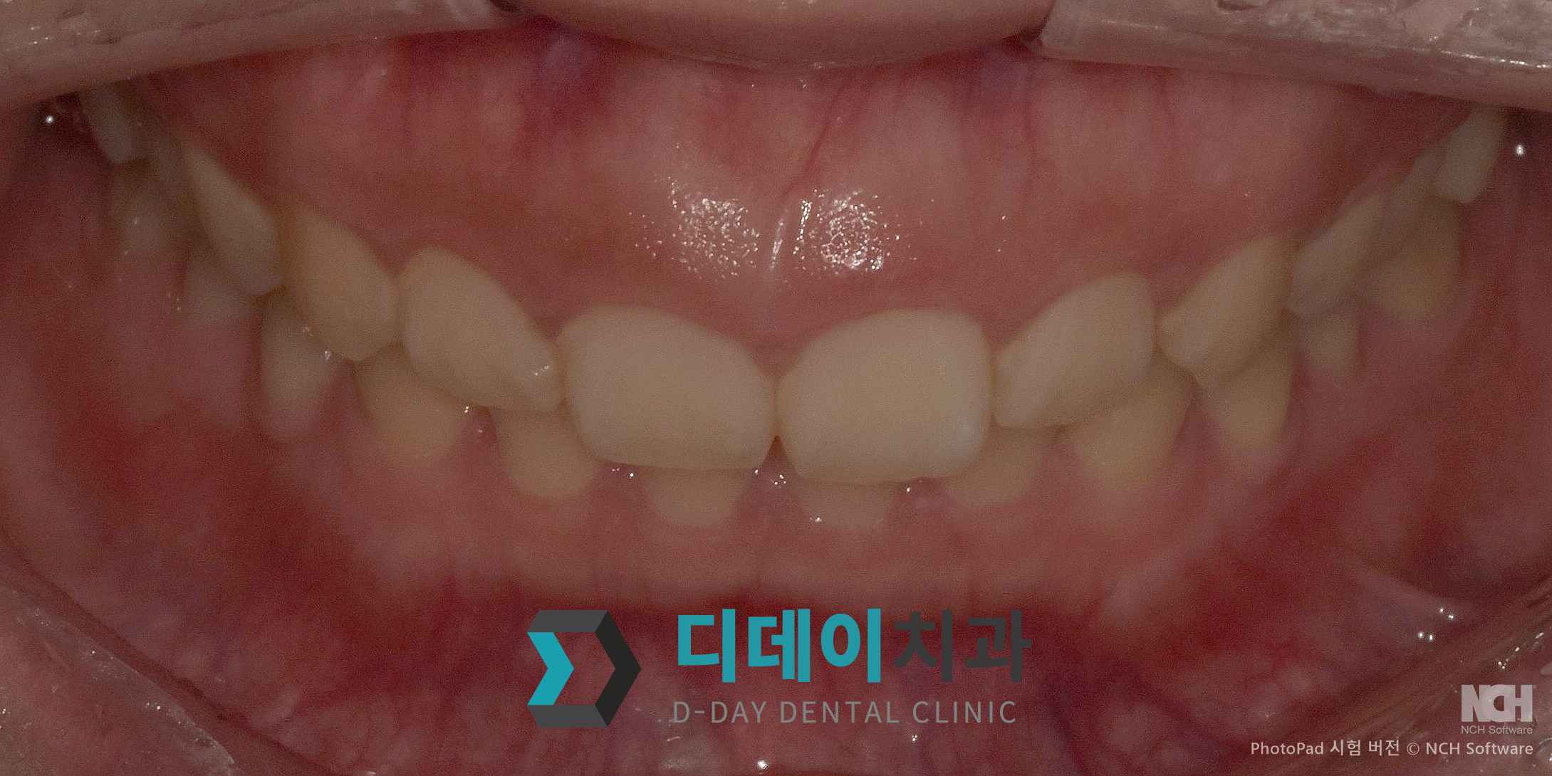 잇몸 성형 치료 전