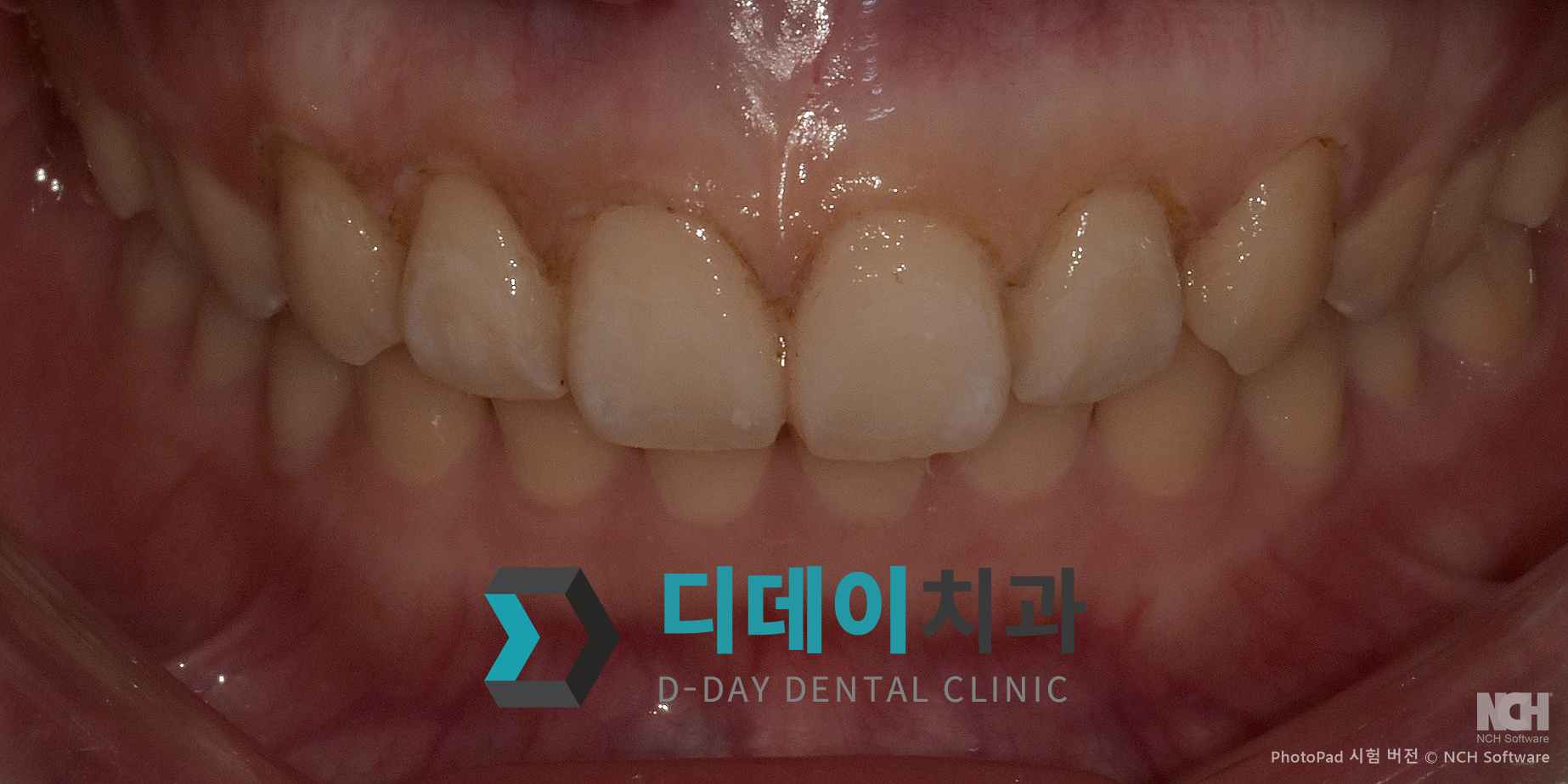 잇몸 성형 치료 후