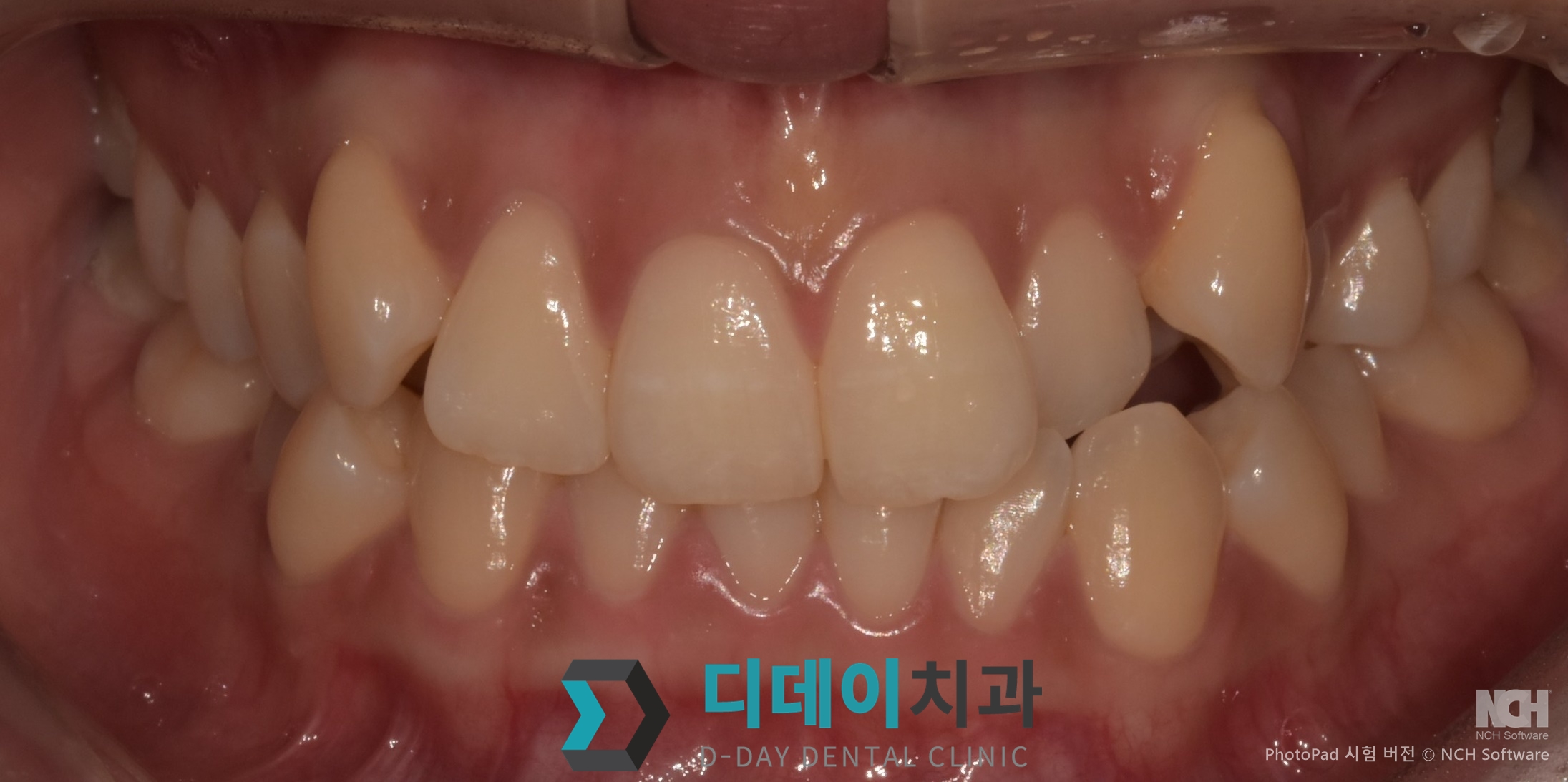 라미네이트 + 잇몸성형 치료 전