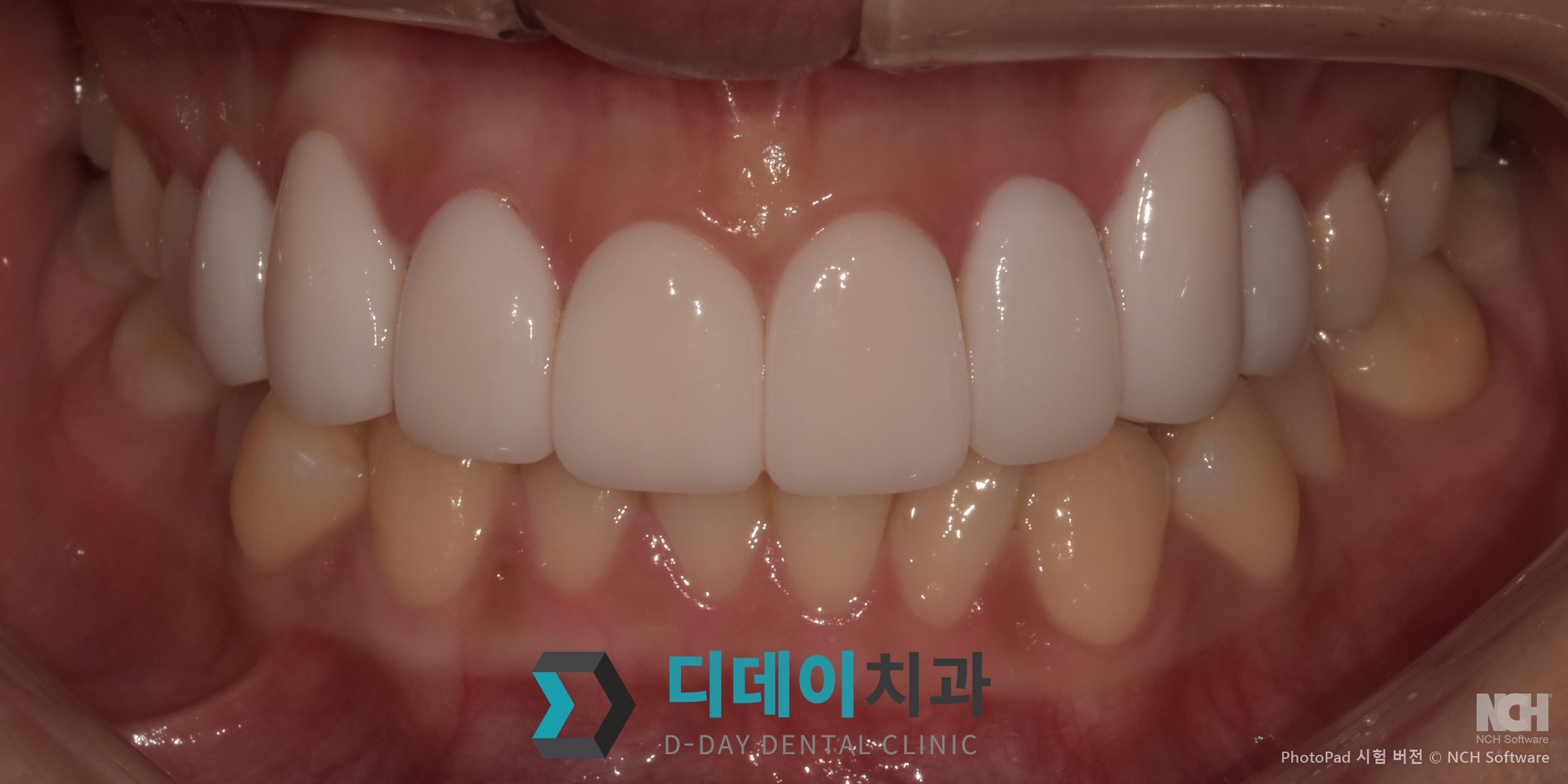 라미네이트 + 잇몸성형 치료 후