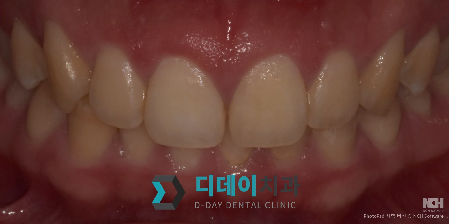 잇몸 성형 치료 후