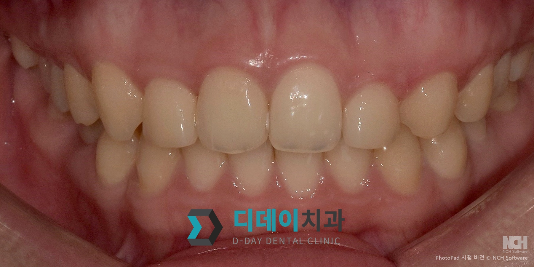 잇몸 성형 치료 전