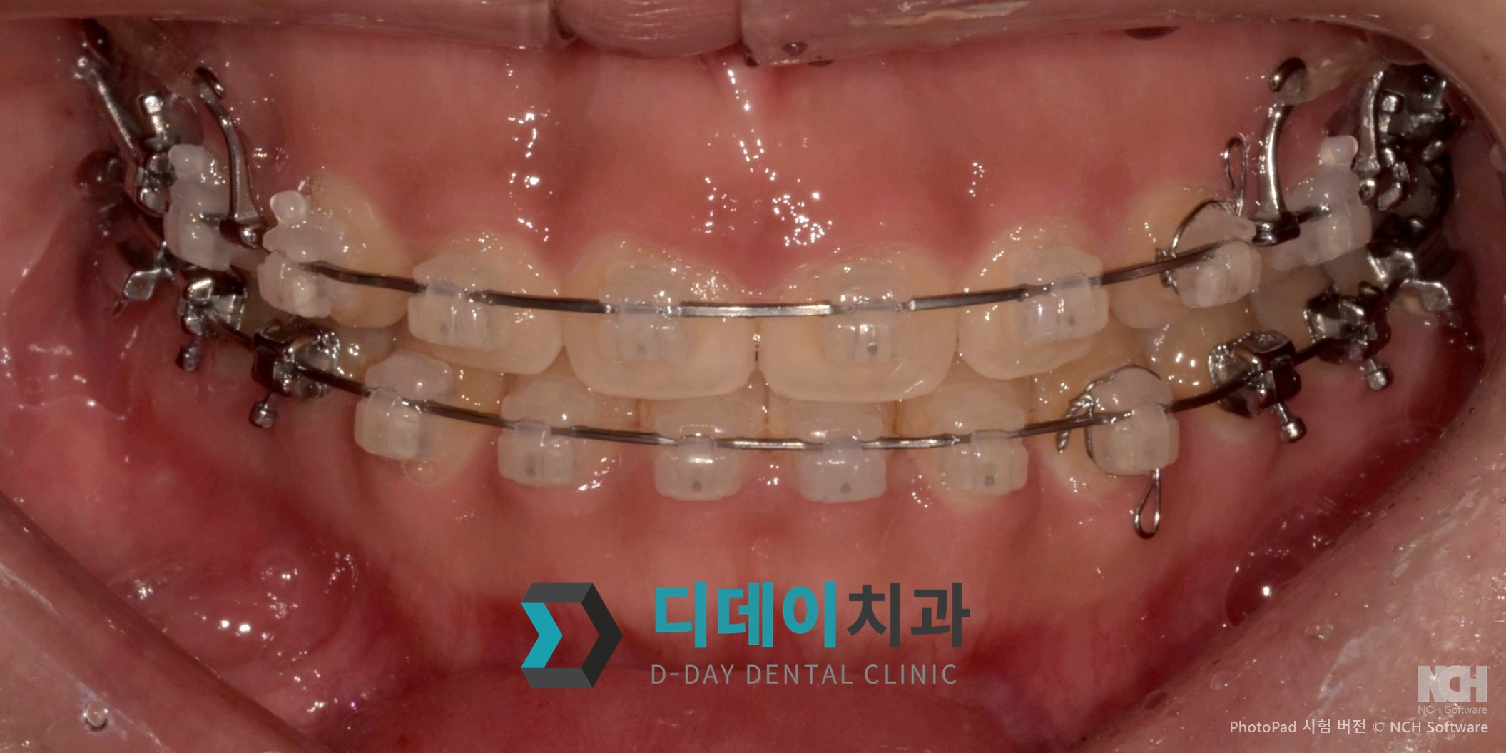 잇몸 성형 치료 전