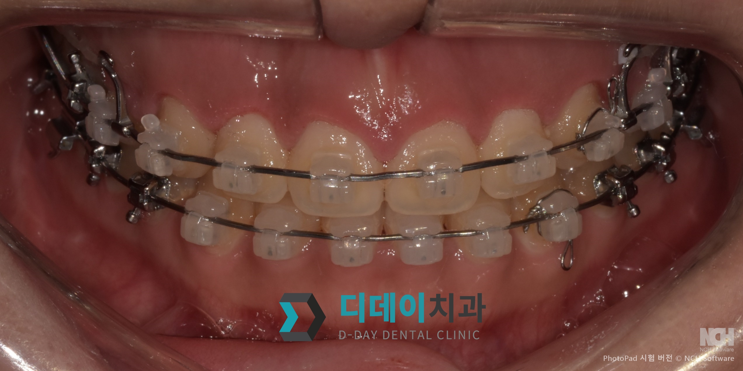 잇몸 성형 치료 후