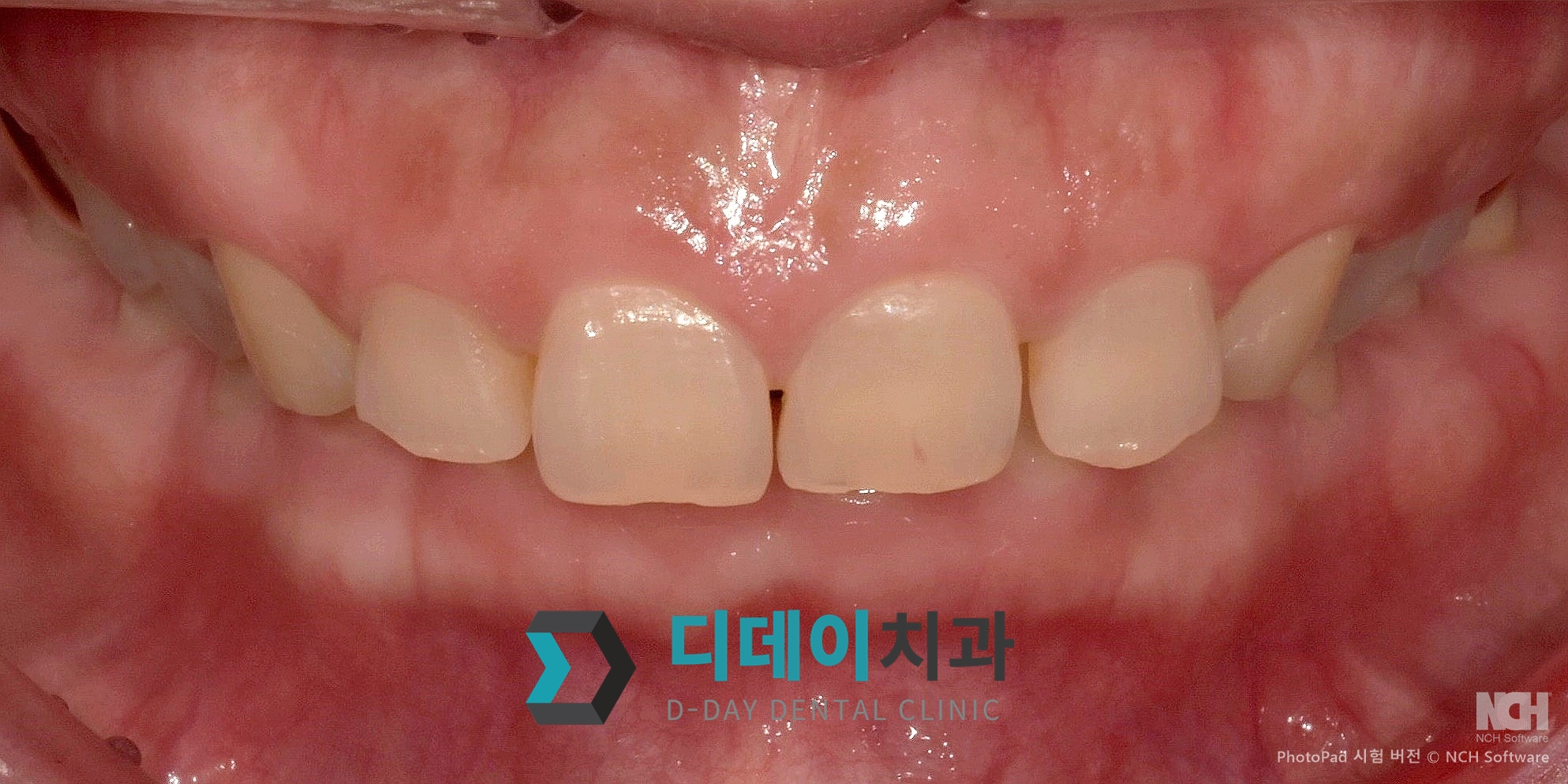 라미네이트 치료 전