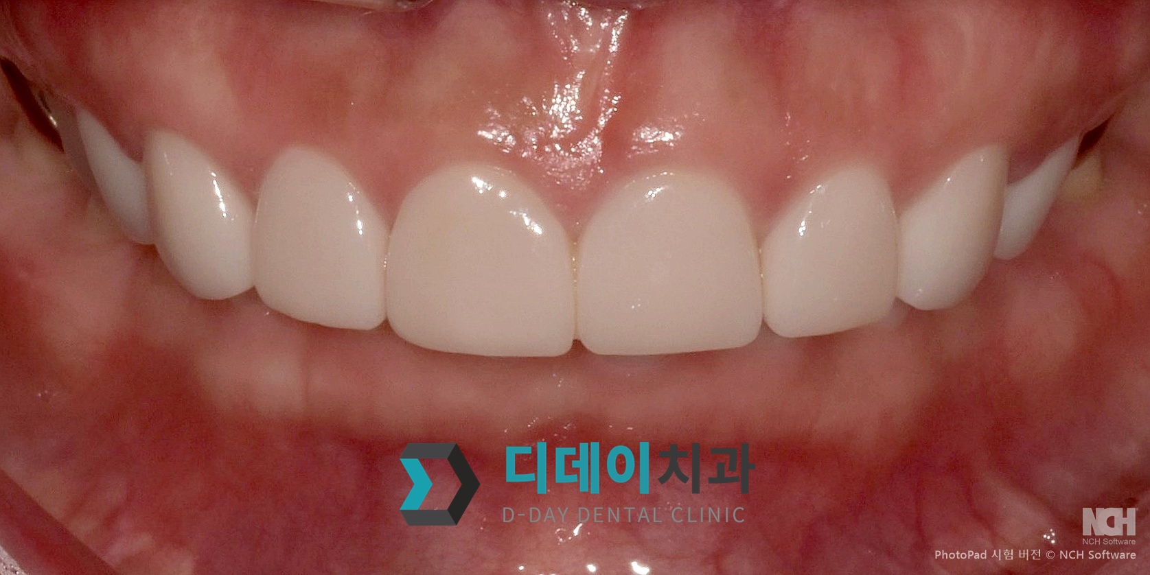 라미네이트 치료 후