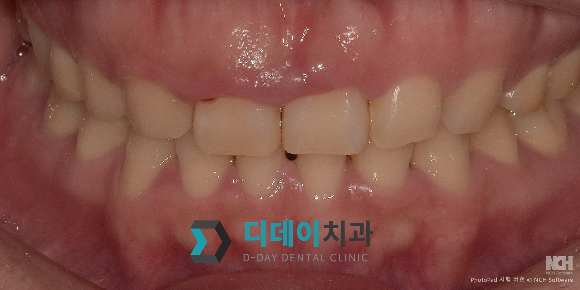 잇몸 성형 치료 전