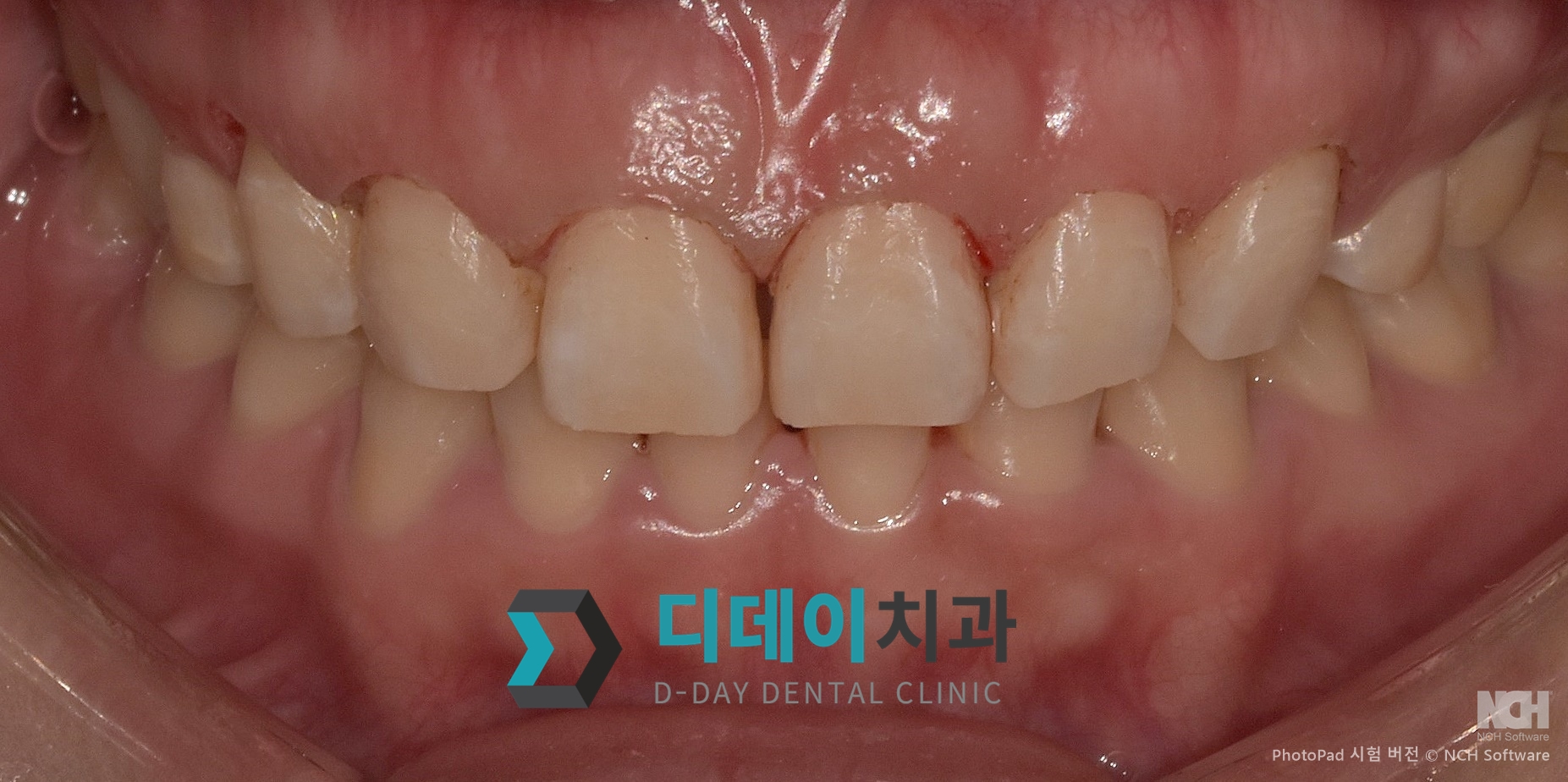 잇몸 성형 치료 후