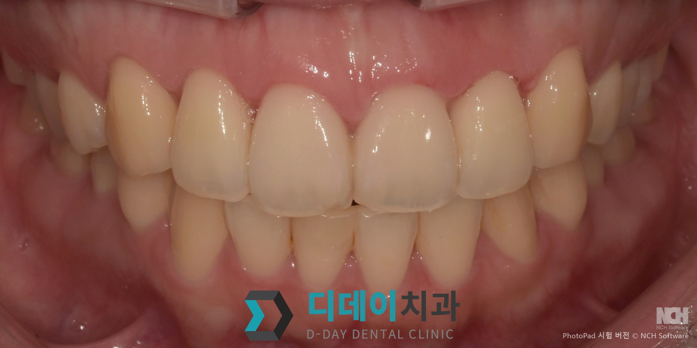 잇몸 성형 치료 후