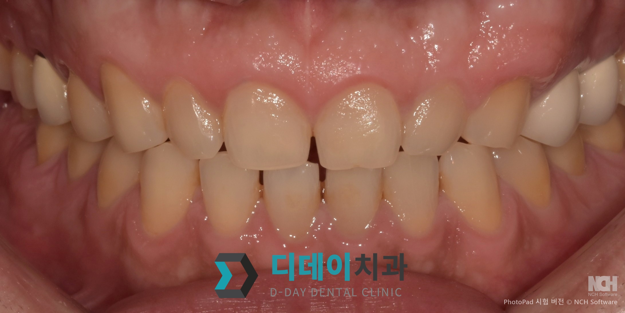 라미네이트 치료 전