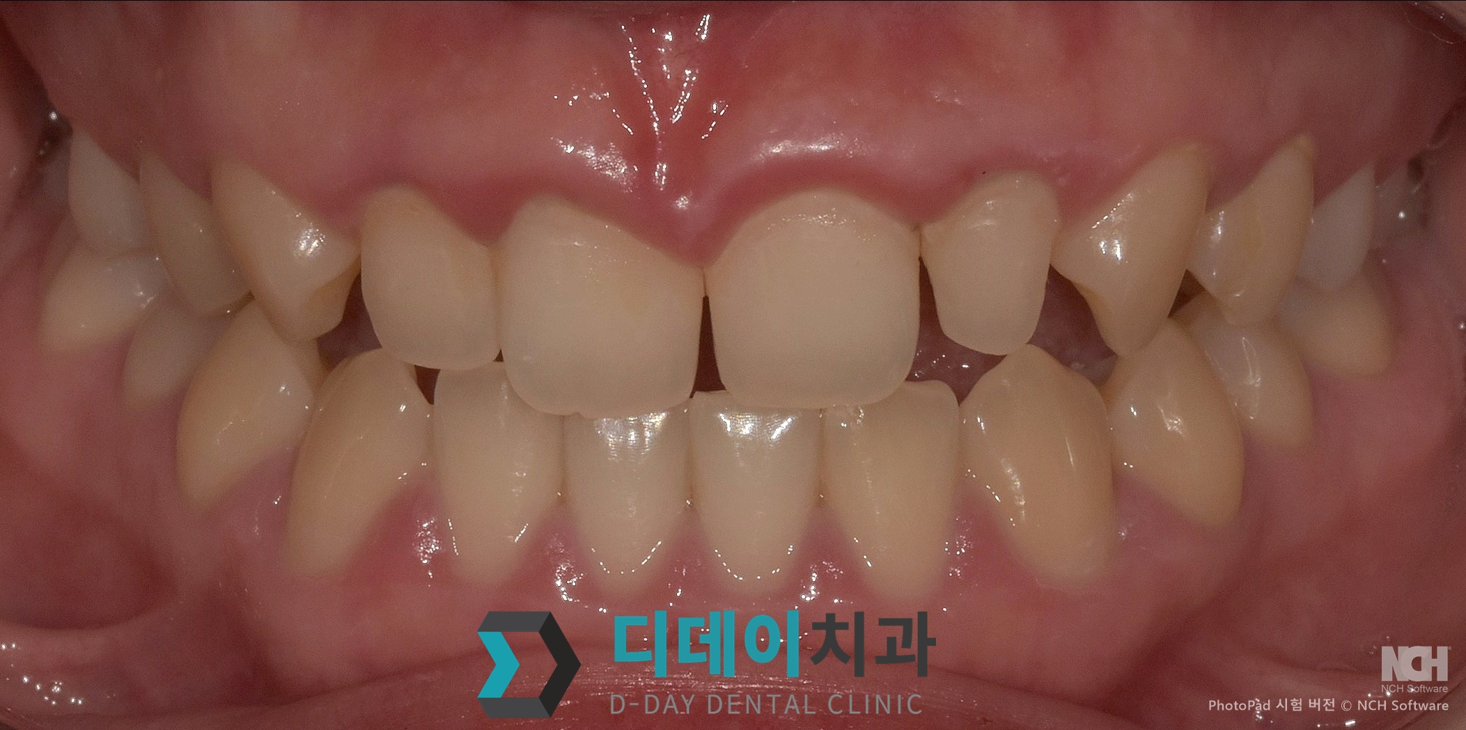 라미네이트 치료 전