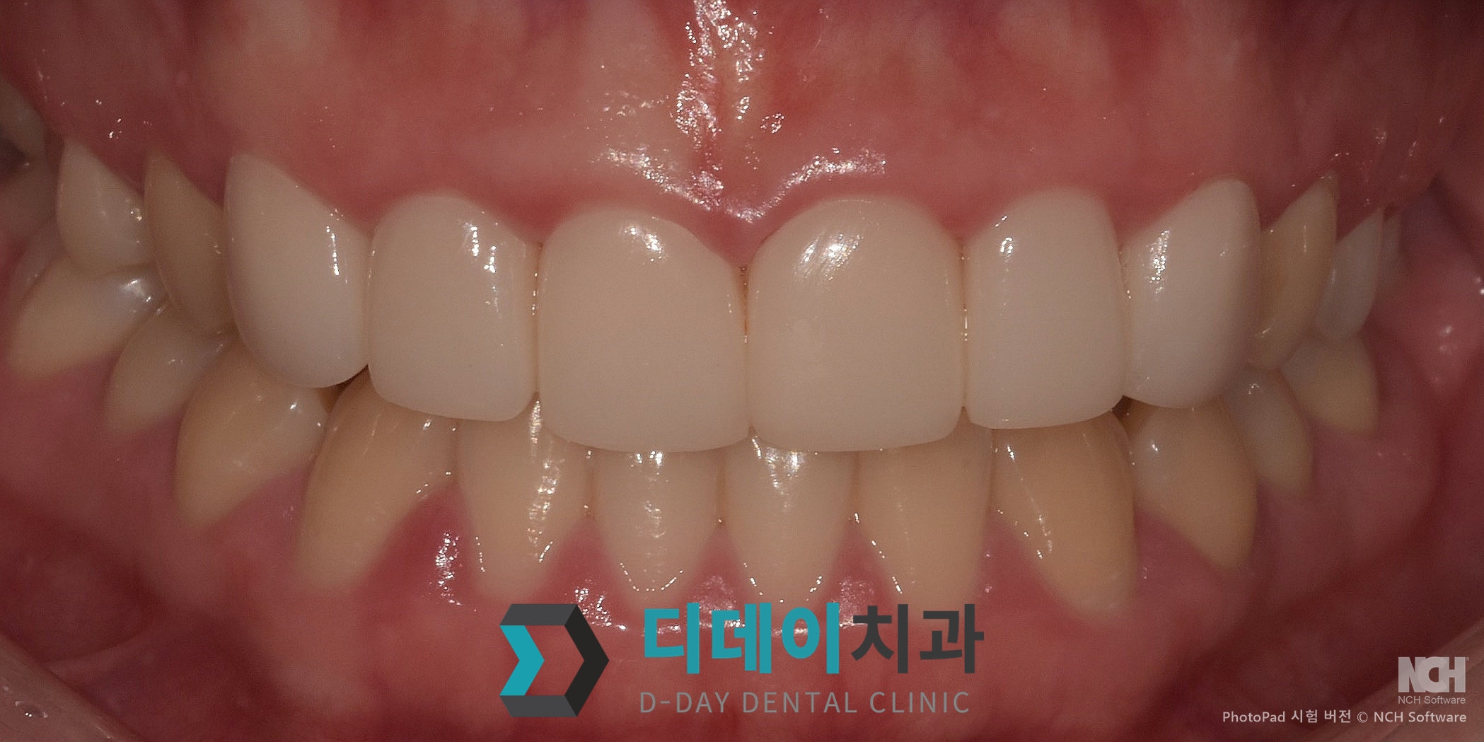 라미네이트 치료 후