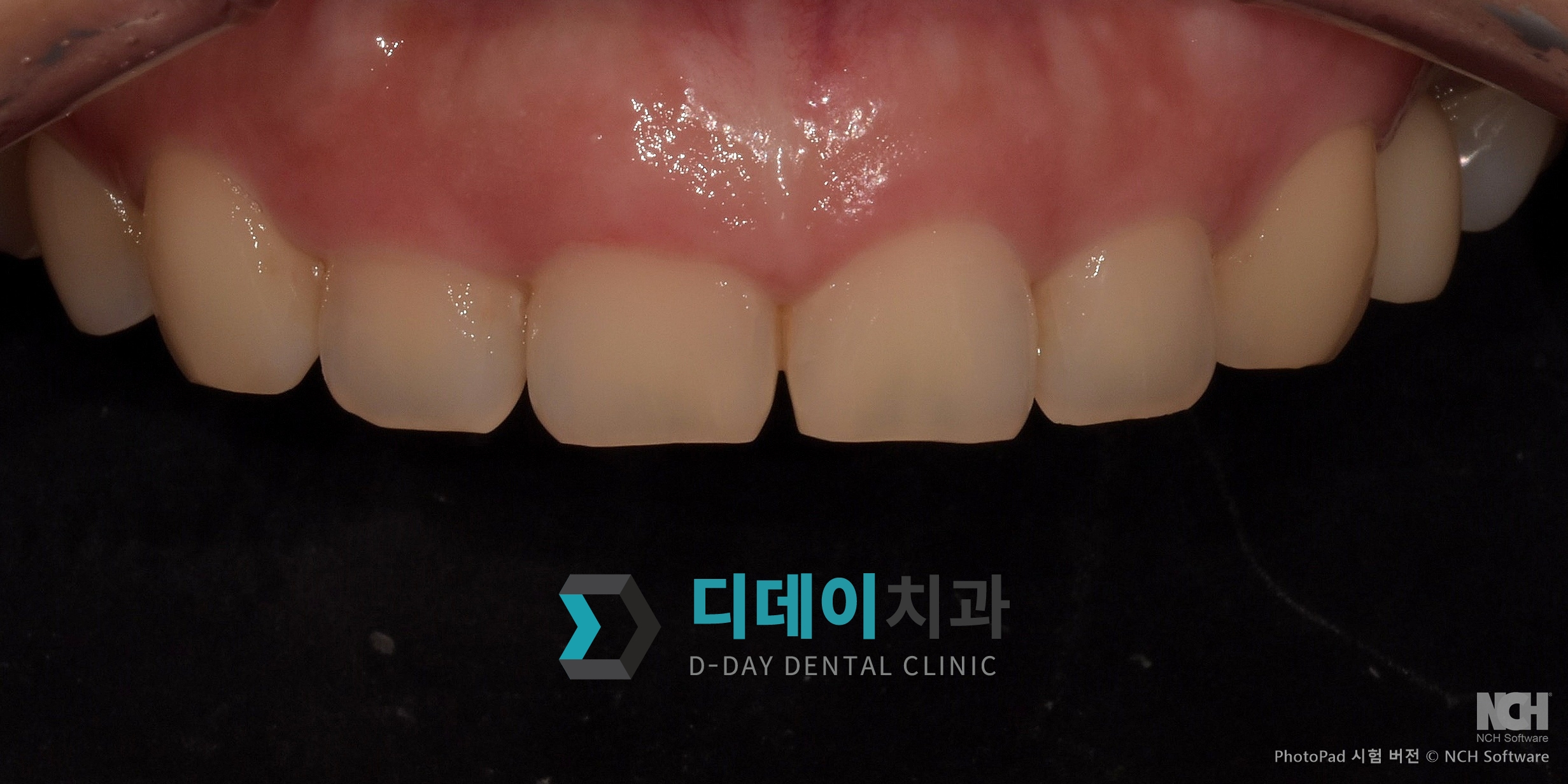 잇몸 성형 치료 전