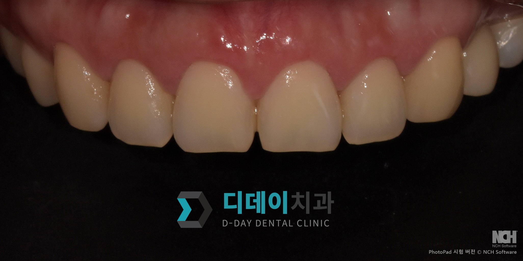 잇몸 성형 치료 후