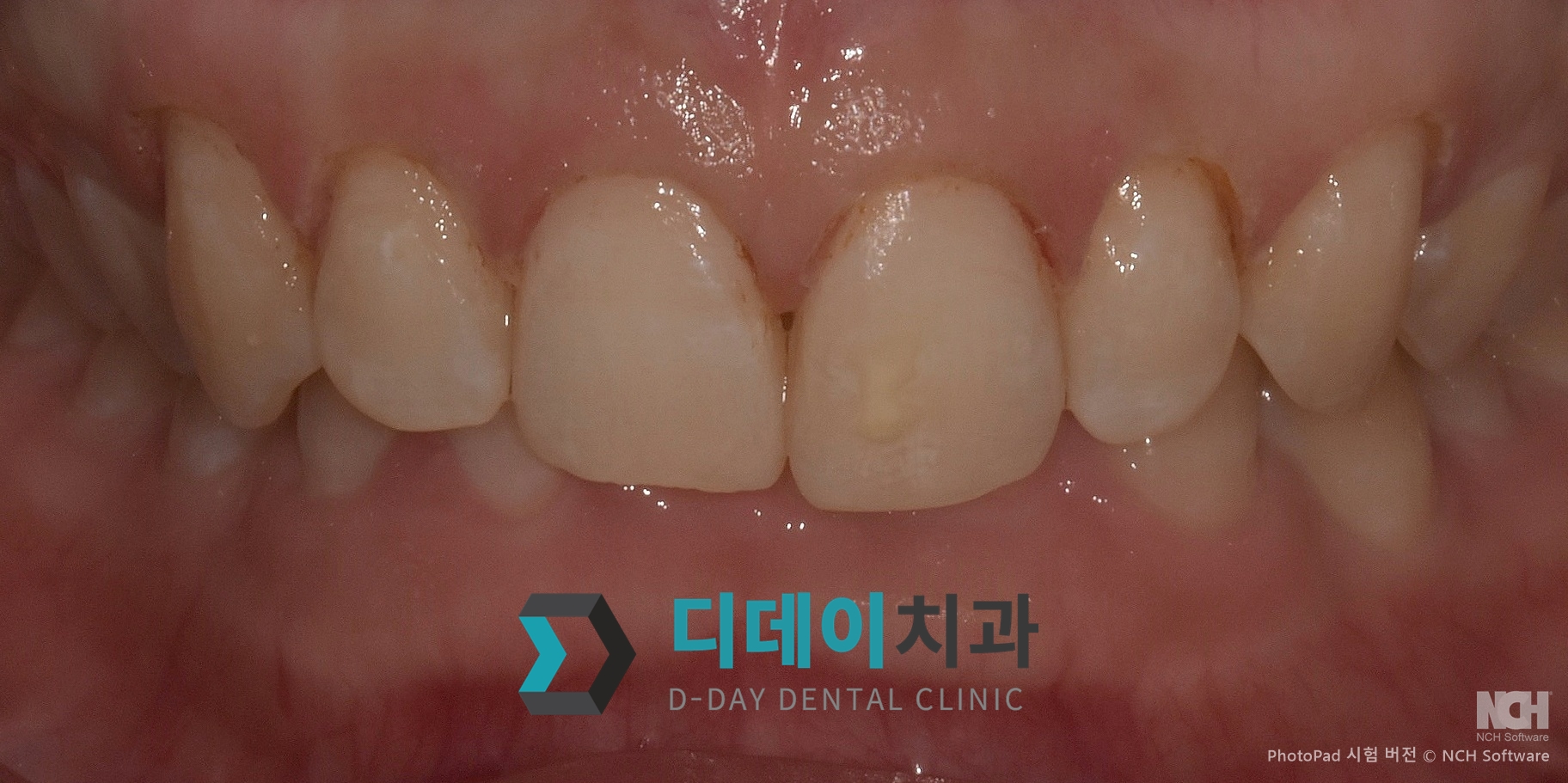 잇몸 성형 치료 후