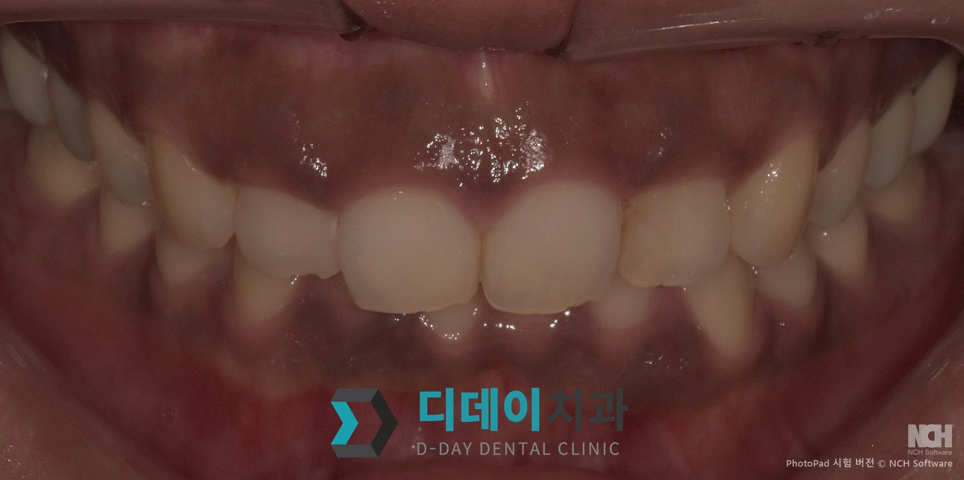 잇몸 미백 치료 전