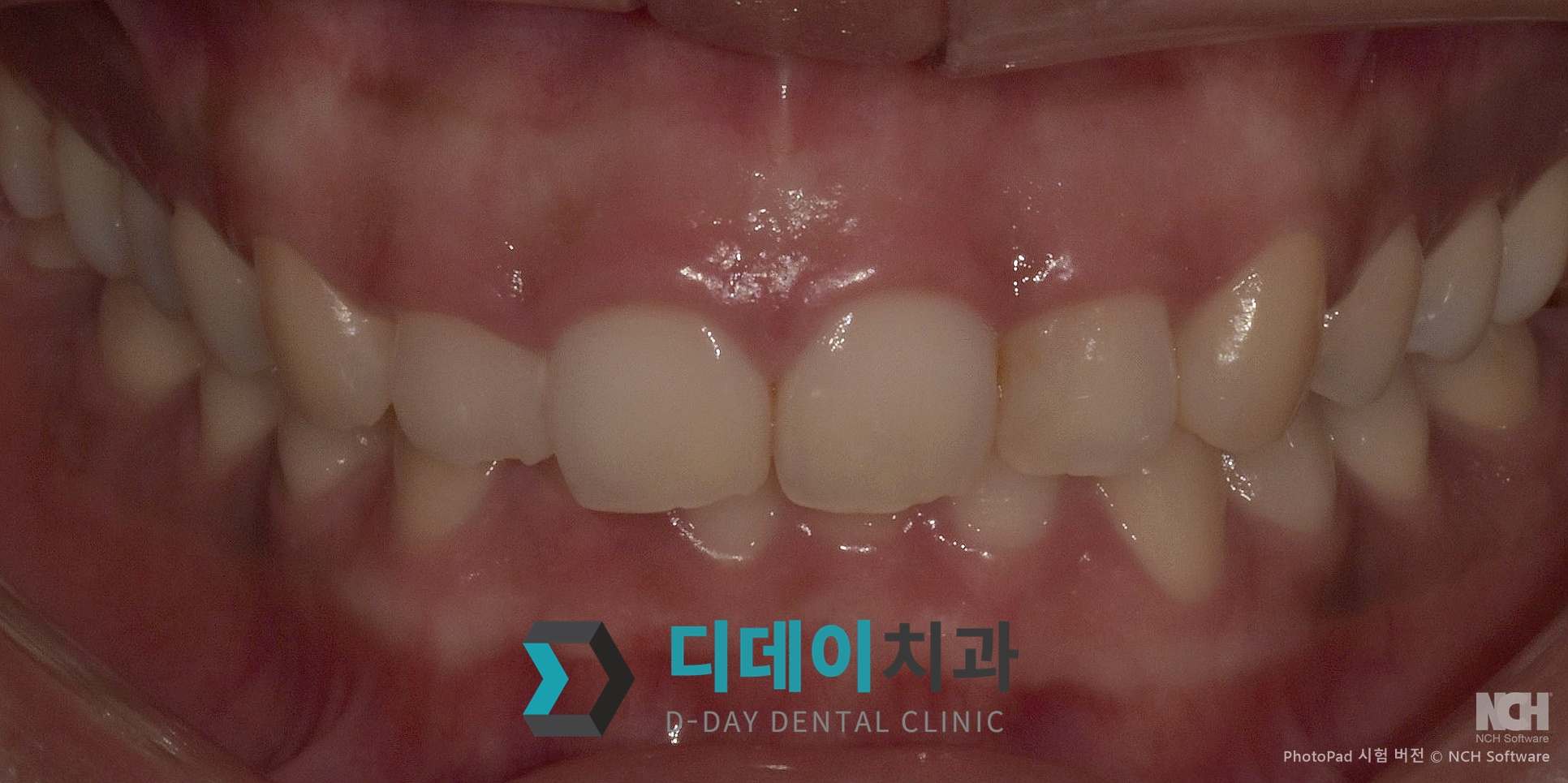 잇몸 미백 치료 후