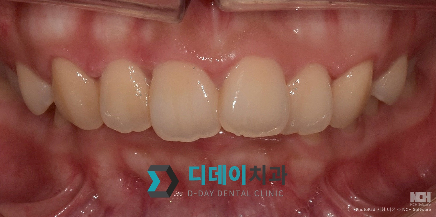 잇몸 성형 치료 후