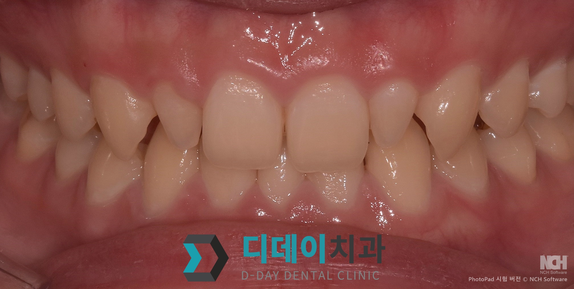 라미네이트 치료 전