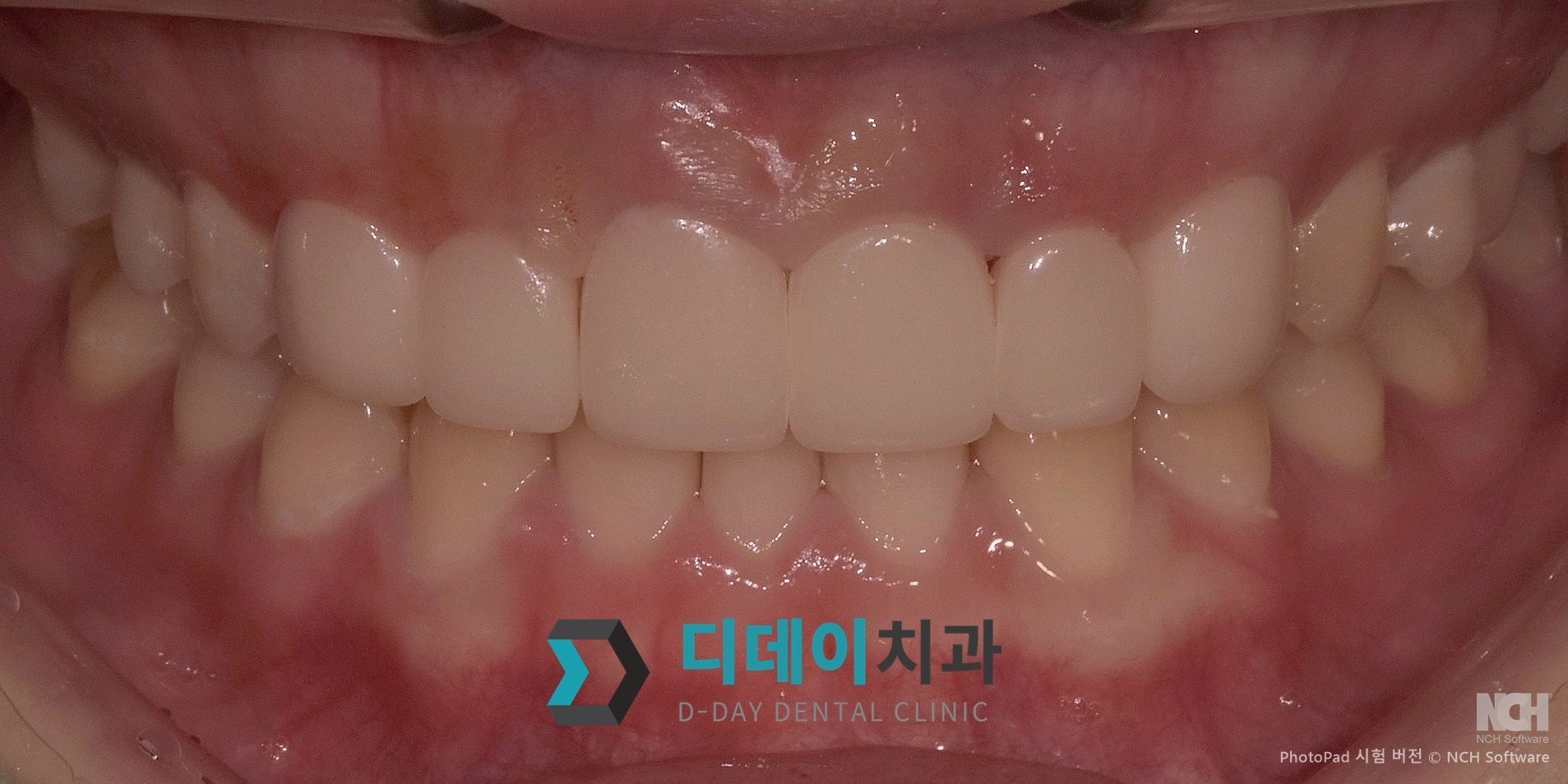 라미네이트 치료 후