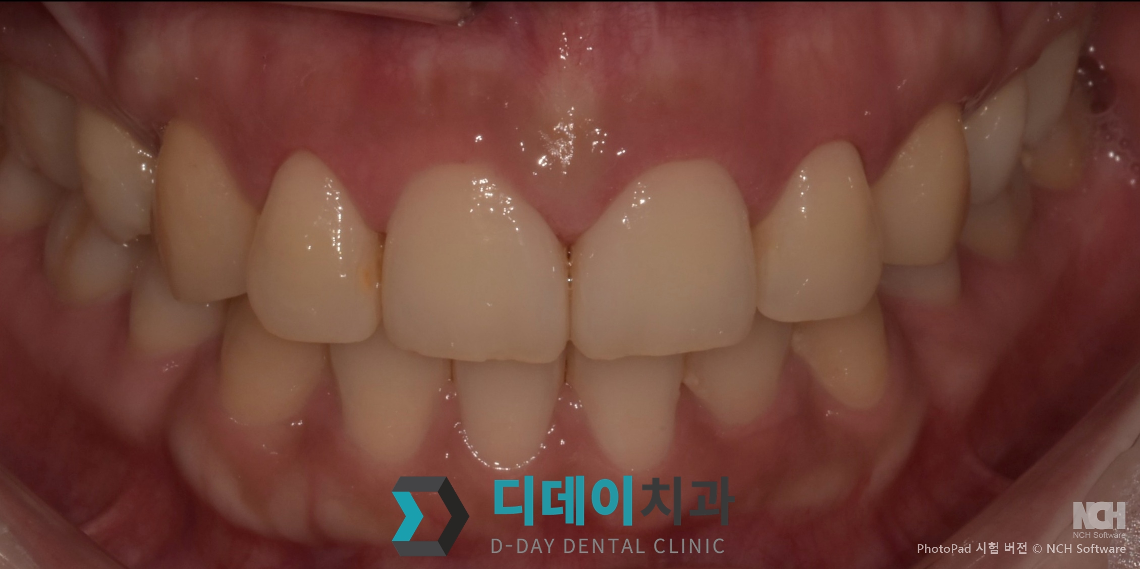 잇몸 성형 치료 후