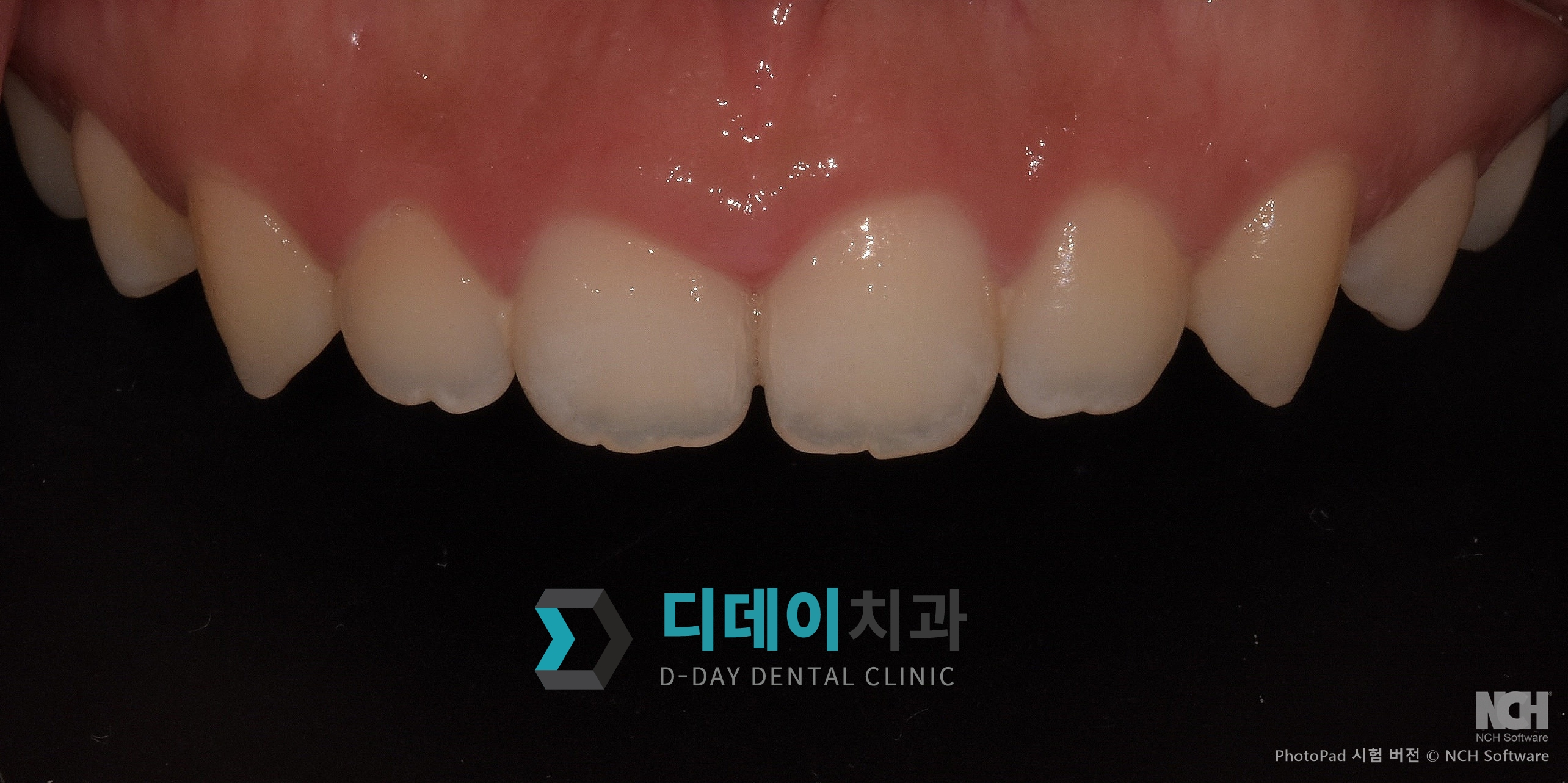 잇몸 성형 치료 전