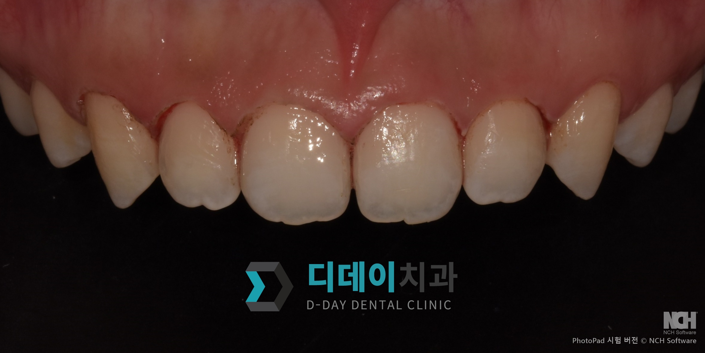 잇몸 성형 치료 후