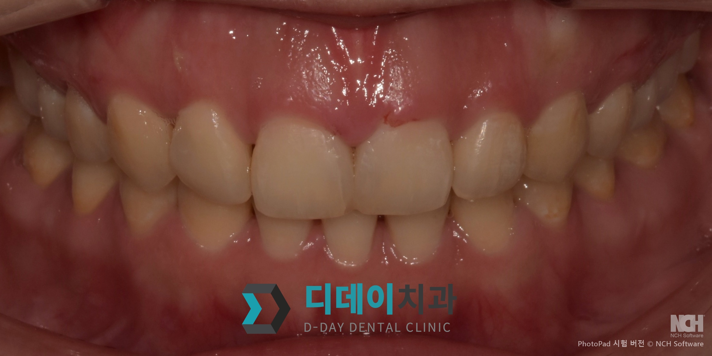 잇몸 성형 치료 전