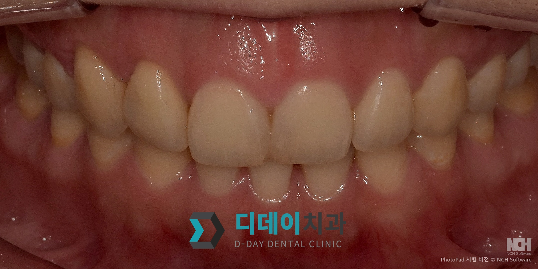 잇몸 성형 치료 후